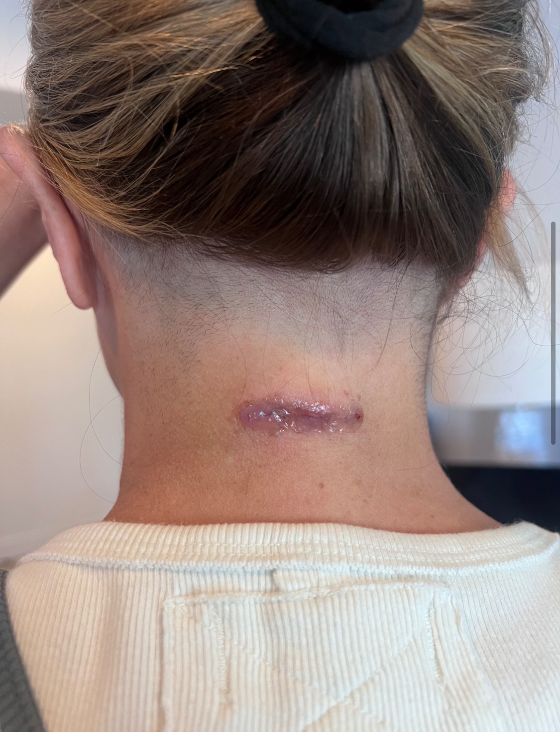 Donate to Nikki's Healing from Complex Spine Surgery campaign photo, 4 of 7