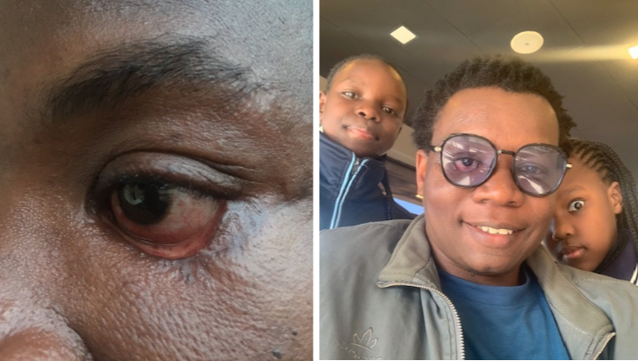 Help Me Restore My Eye lip , For Me and My Daughters.