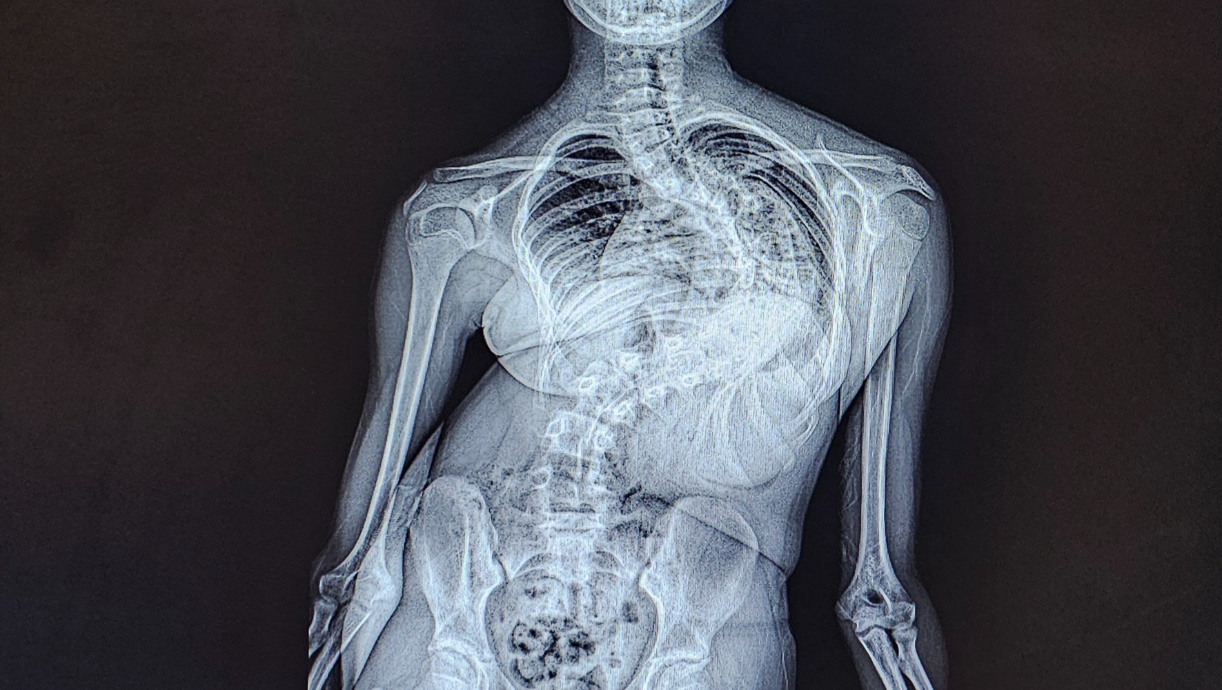 Support Jamie's Daughter's Spinal Surgery Journey photo