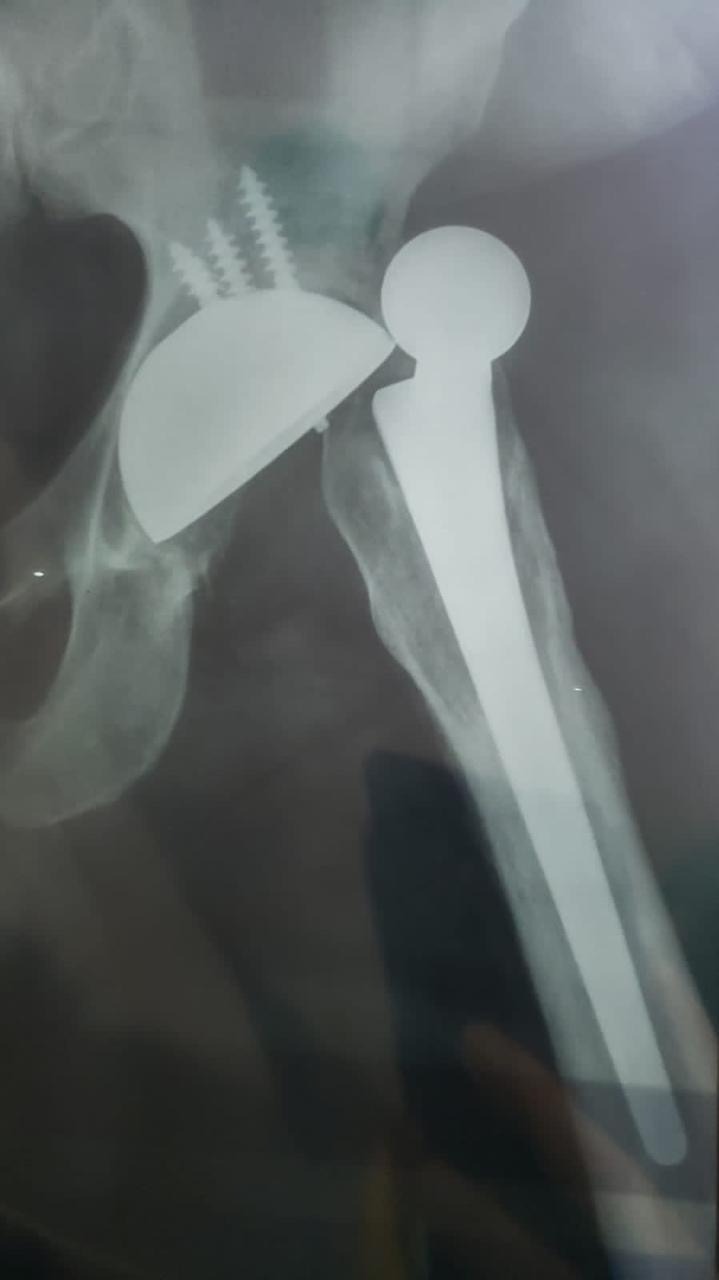 Help Keneth Walk Again After 13 Surgeries campaign photo, 7 of 8