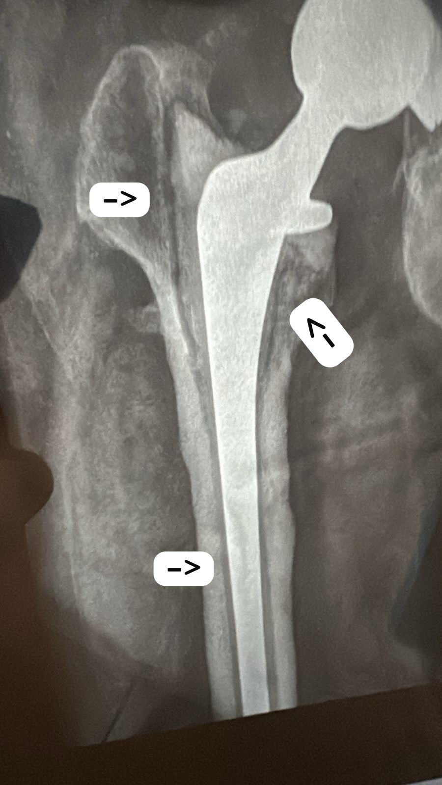 Help Keneth Walk Again After 13 Surgeries campaign photo, 5 of 8