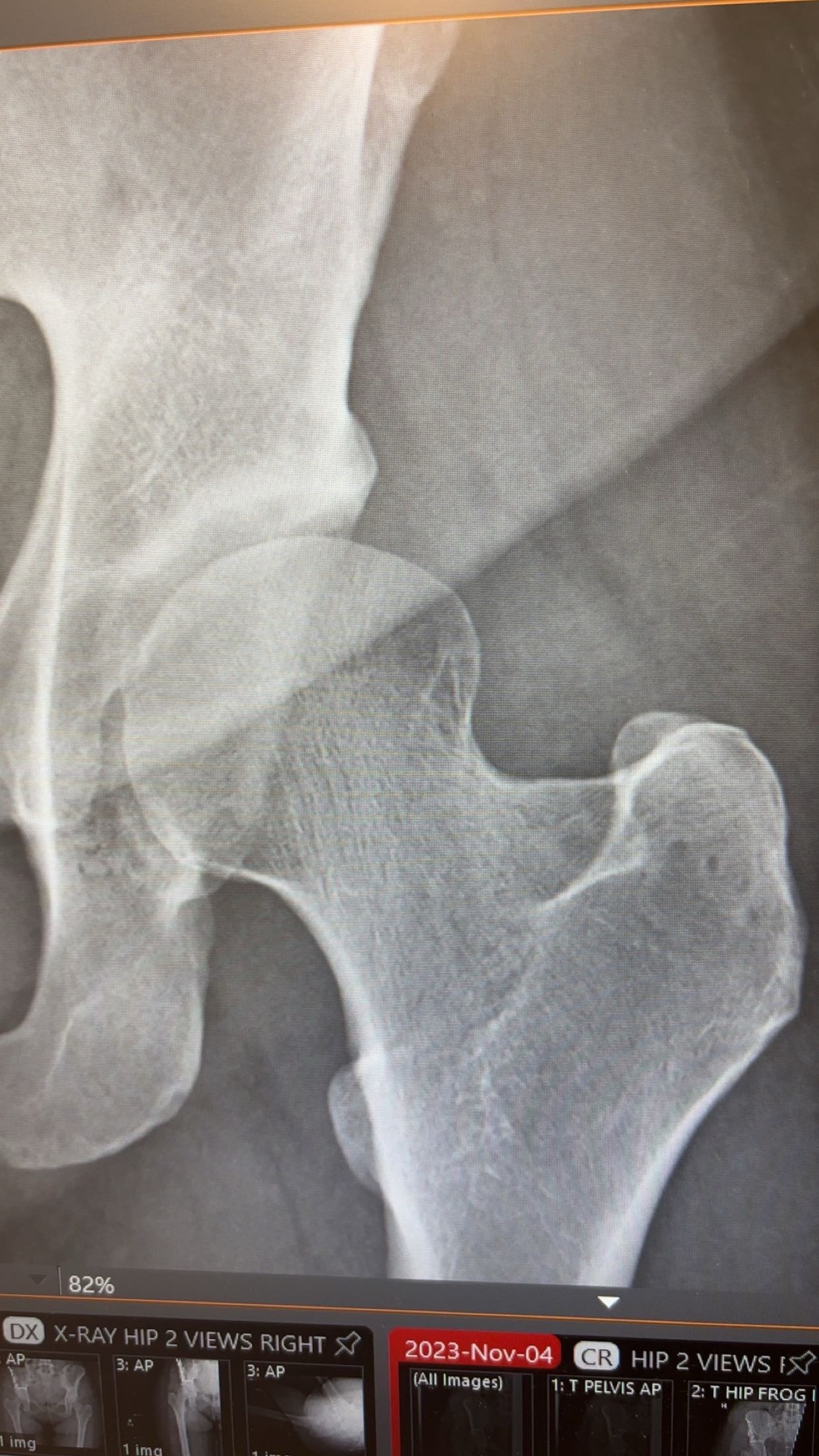 Help a Single Mom Walk Without Pain Again – Hip Replacement campaign photo, 4 of 5