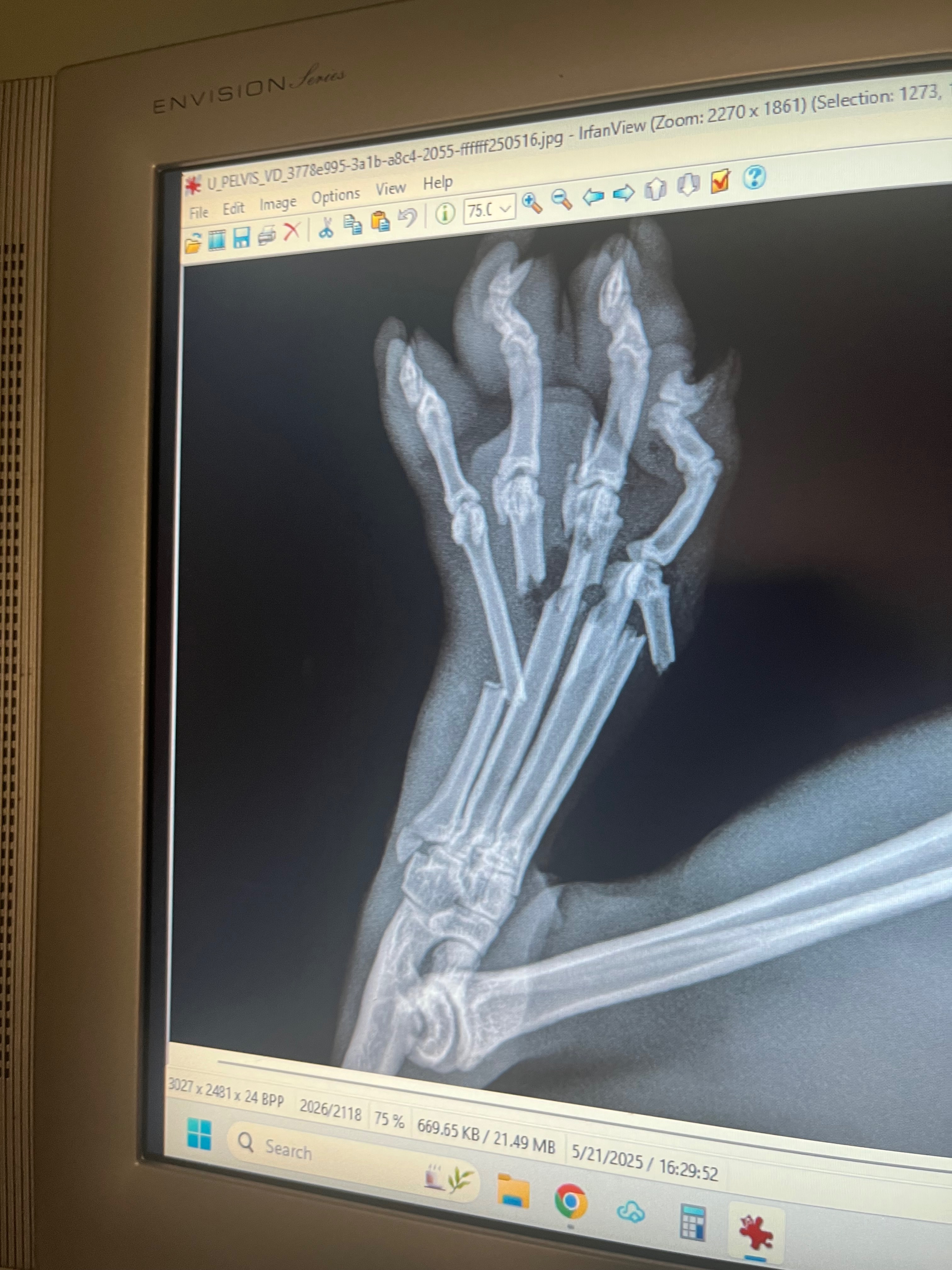 Support Alex's Amputation Surgery Fund campaign photo, 7 of 8