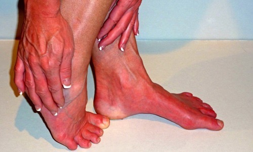 Support Kimberly's Fight Against Erythromelalgia campaign photo, 6 of 7
