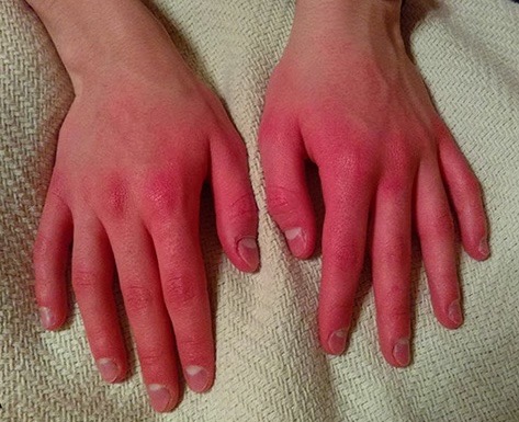 Support Kimberly's Fight Against Erythromelalgia campaign photo, 2 of 7