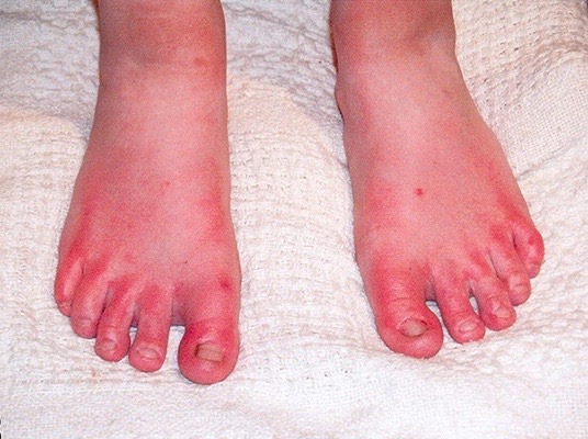 Support Kimberly's Fight Against Erythromelalgia campaign photo, 4 of 7