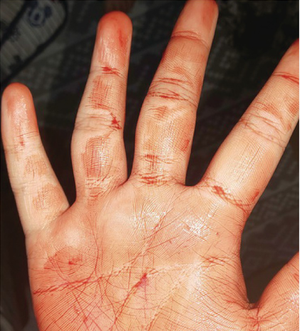 Support Kimberly's Fight Against Erythromelalgia campaign photo, 5 of 7