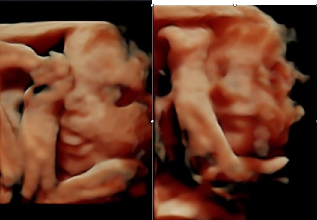 Support Adeline Jane's Adoption Journey campaign photo, 2 of 4