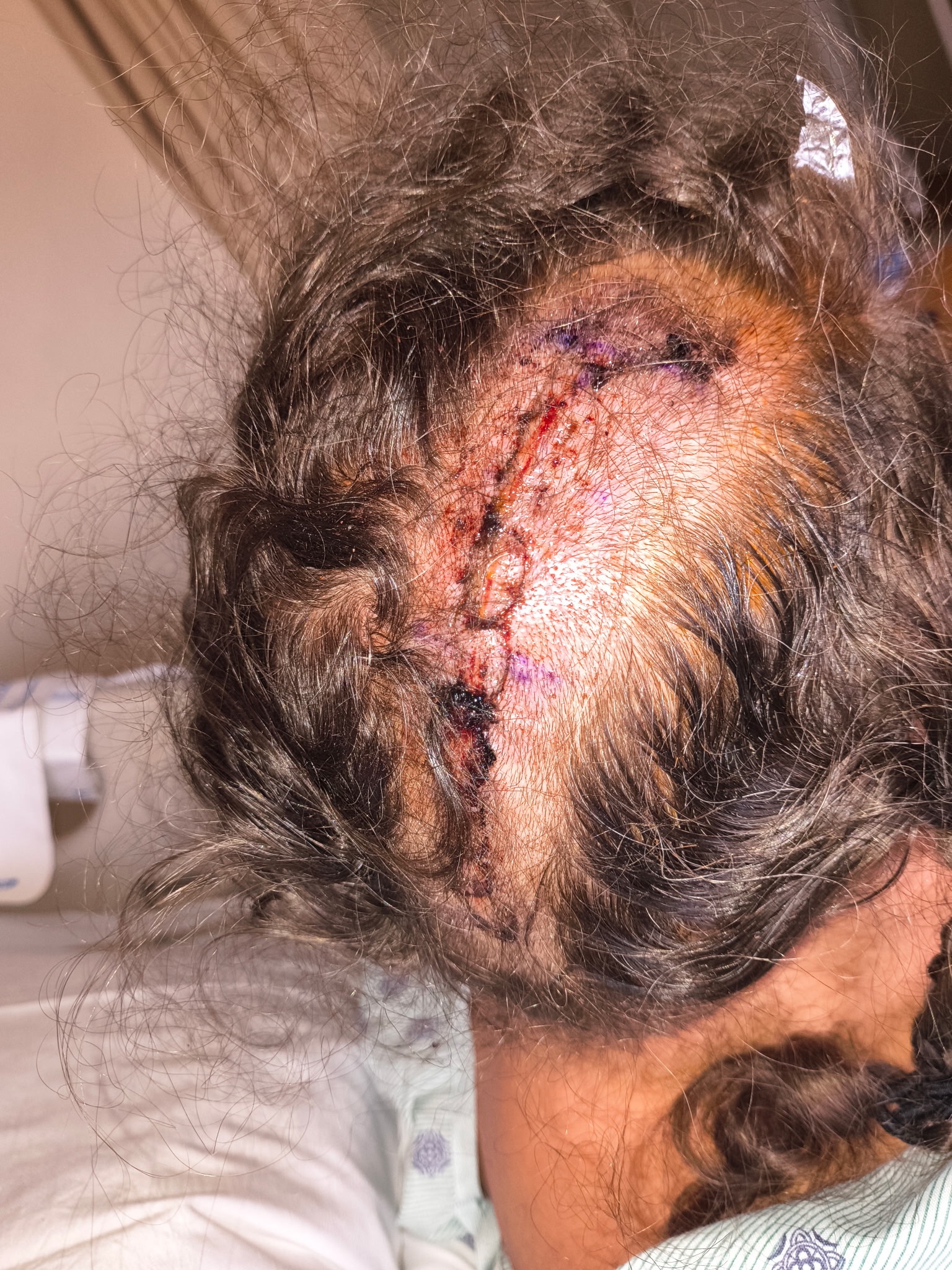 Support Recovery After Brain Surgery campaign photo, 2 of 4