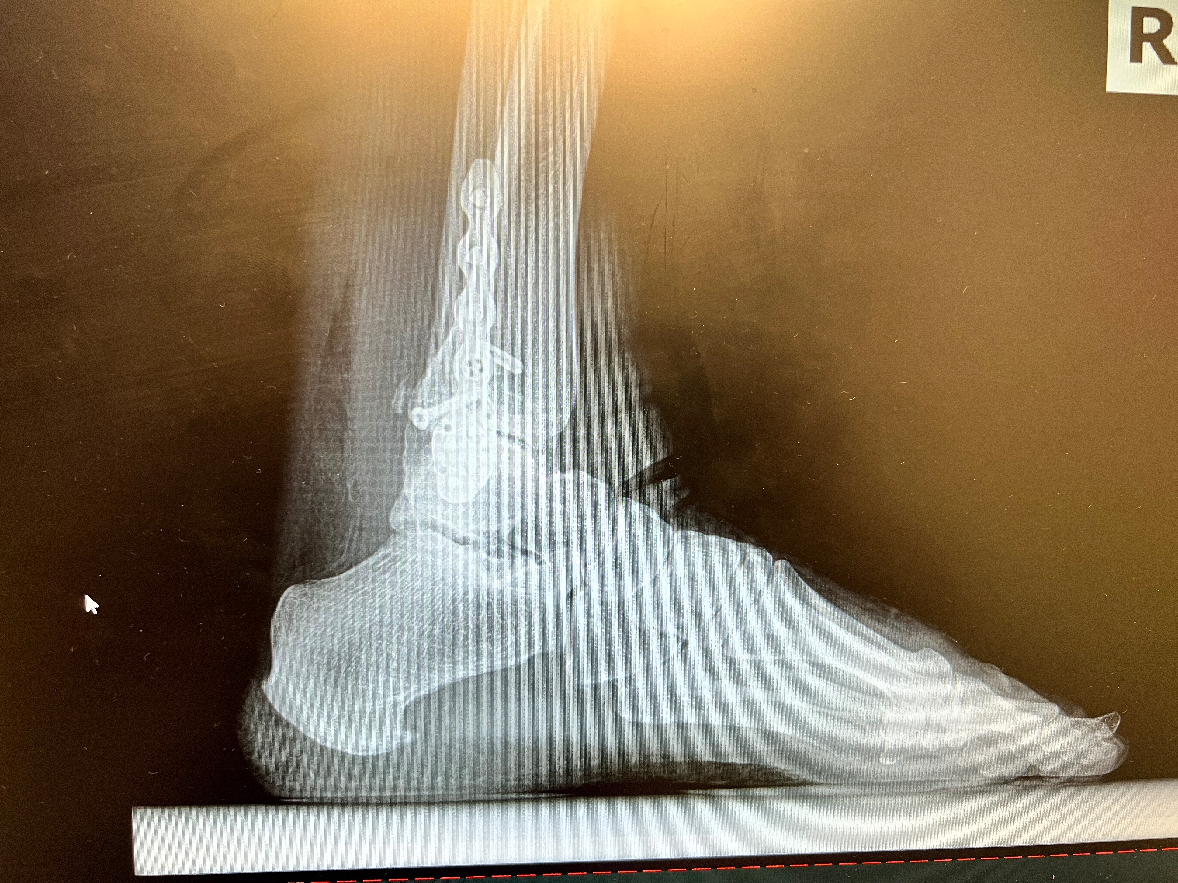 Help Overcome Medical Debt from Ankle Surgery campaign photo, 2 of 4