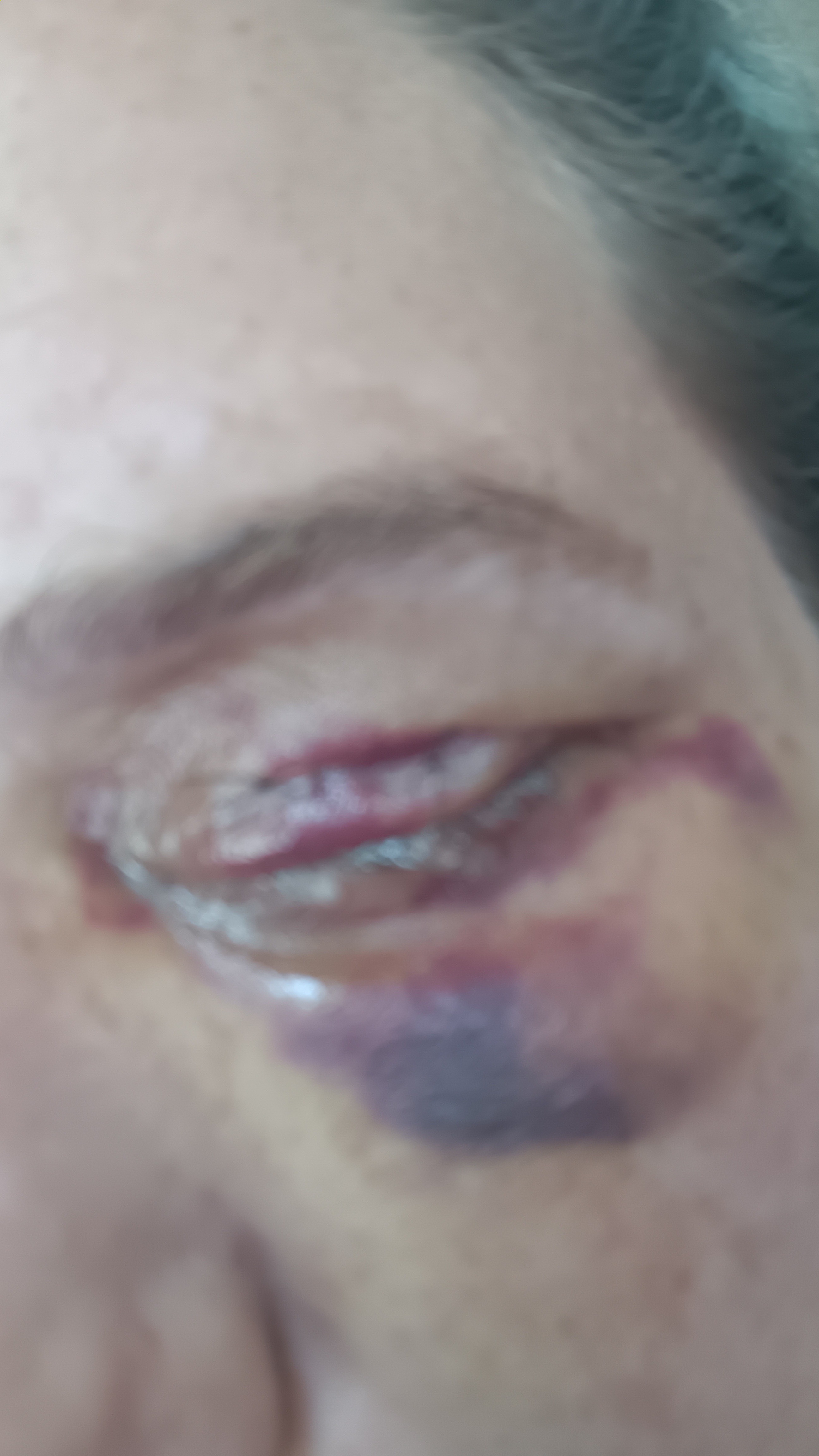Help Connie cover Surgery Costs from eye removal campaign photo, 2 of 8