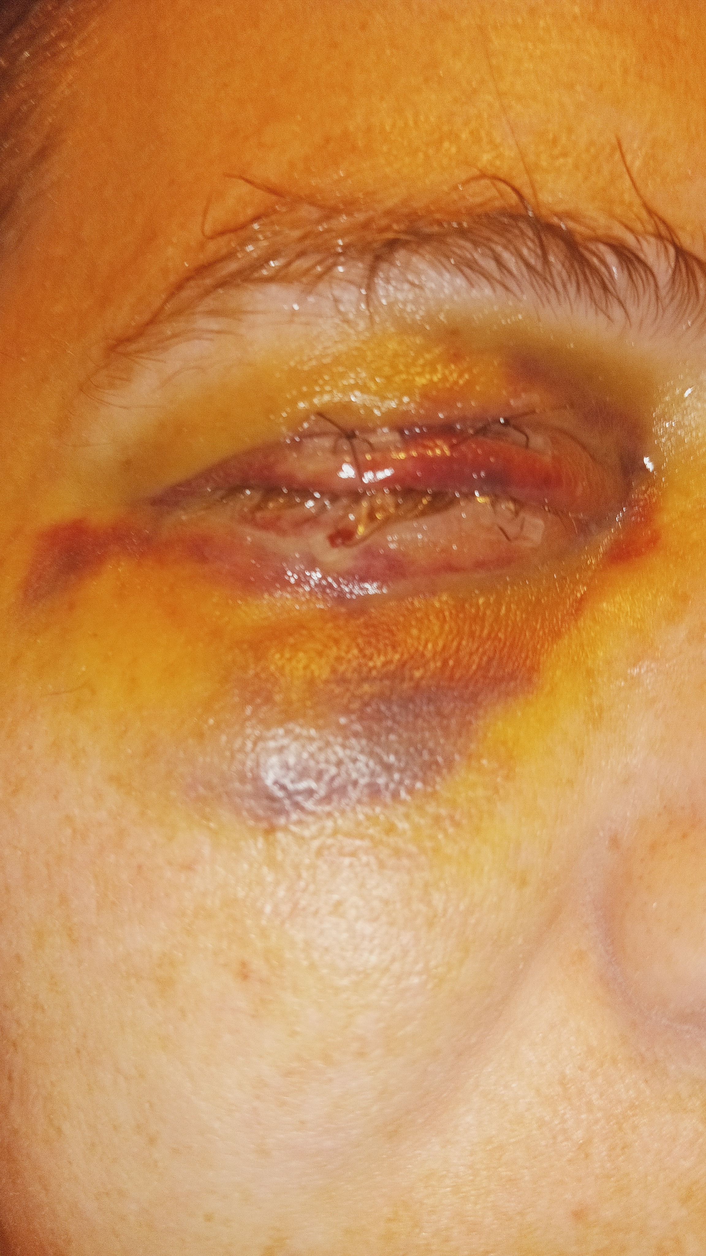 Help Connie cover Surgery Costs from eye removal campaign photo, 4 of 8