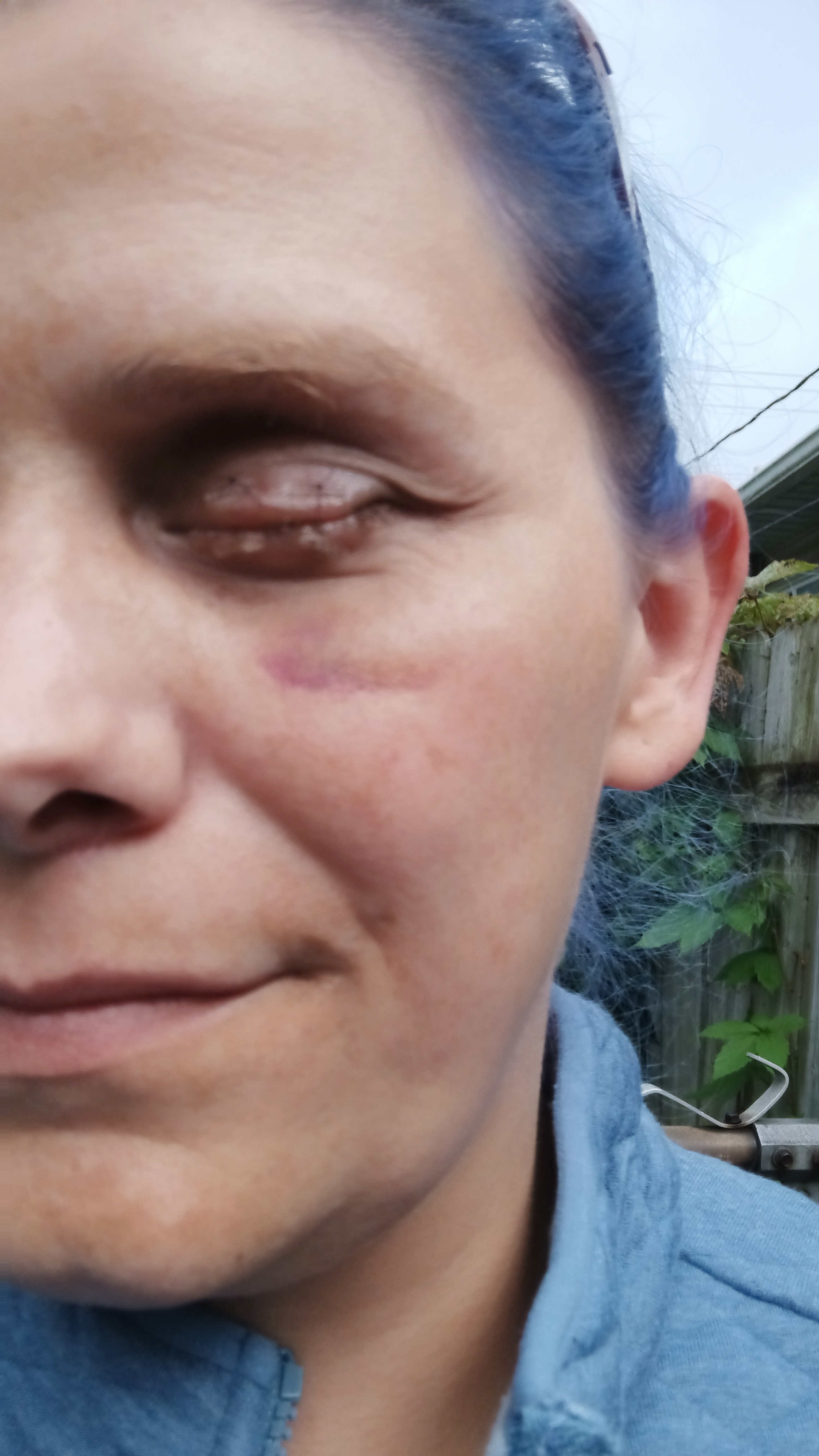Help Connie cover Surgery Costs from eye removal campaign photo, 5 of 8