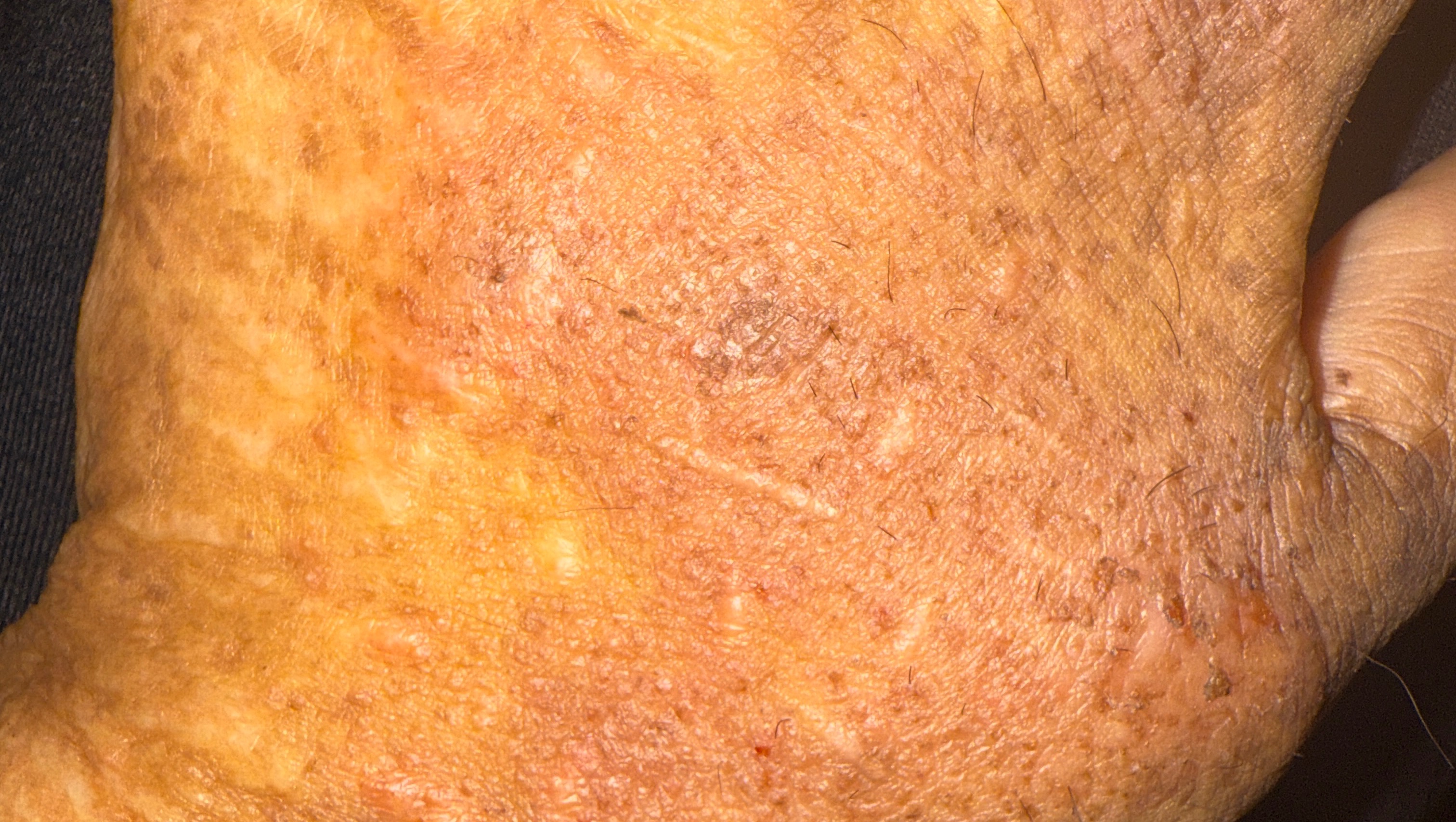 Get surgery for scars photo