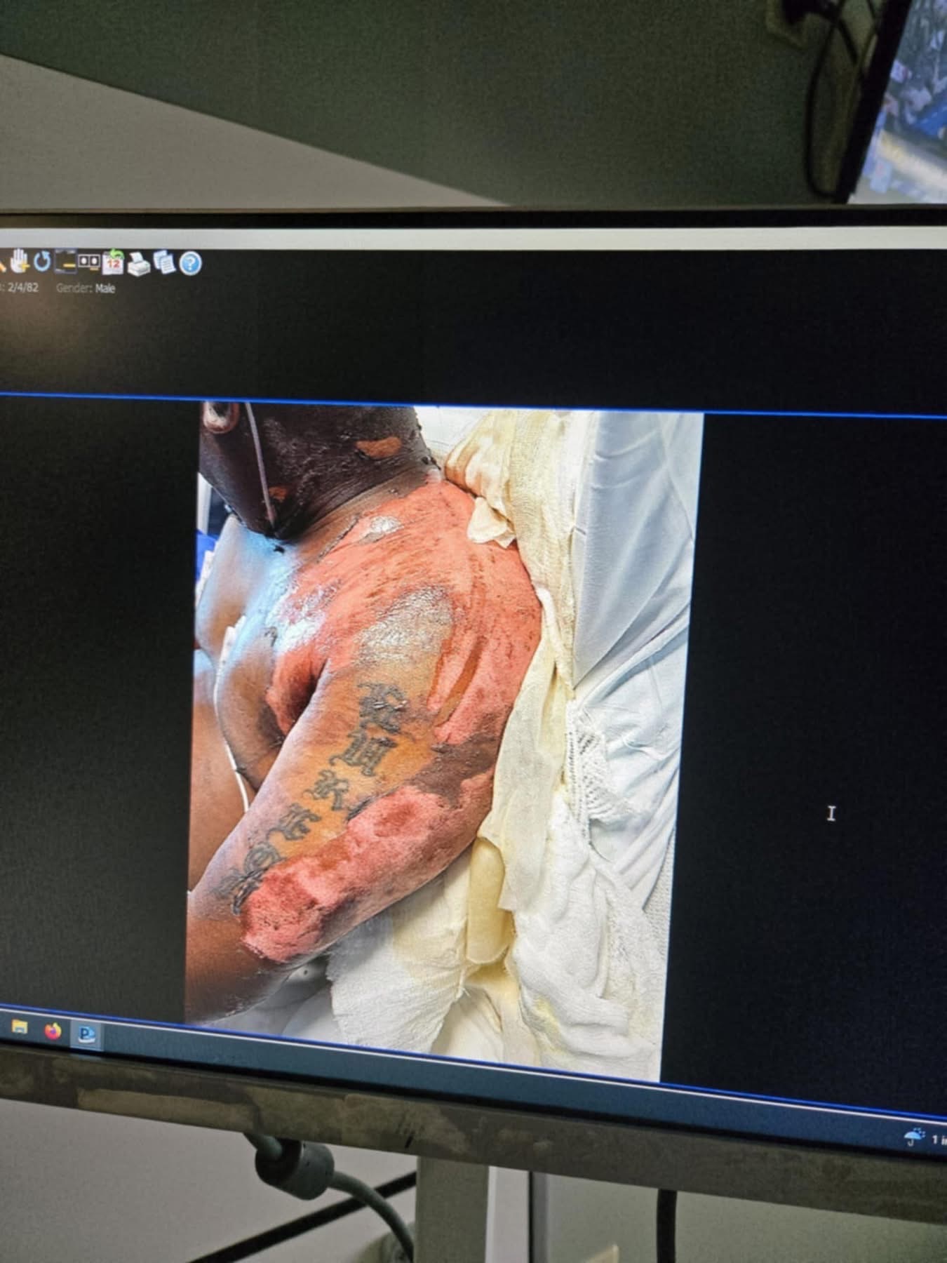 From Burn Injury to Recovery – Help My Brother Rebuild campaign photo, 4 of 5