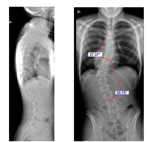 Help Christian Breathe: Urgent Spine Surgery campaign photo, 2 of 4
