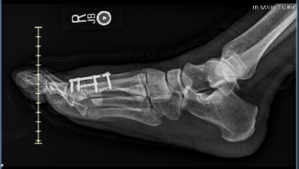 Help Cody Get Back on His Feet photo