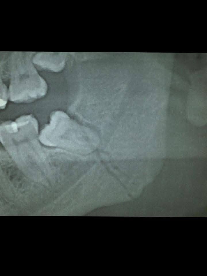 Deteniendo el Deterioro: Ayuda para mi Tratamiento Dental campaign photo, 2 of 4