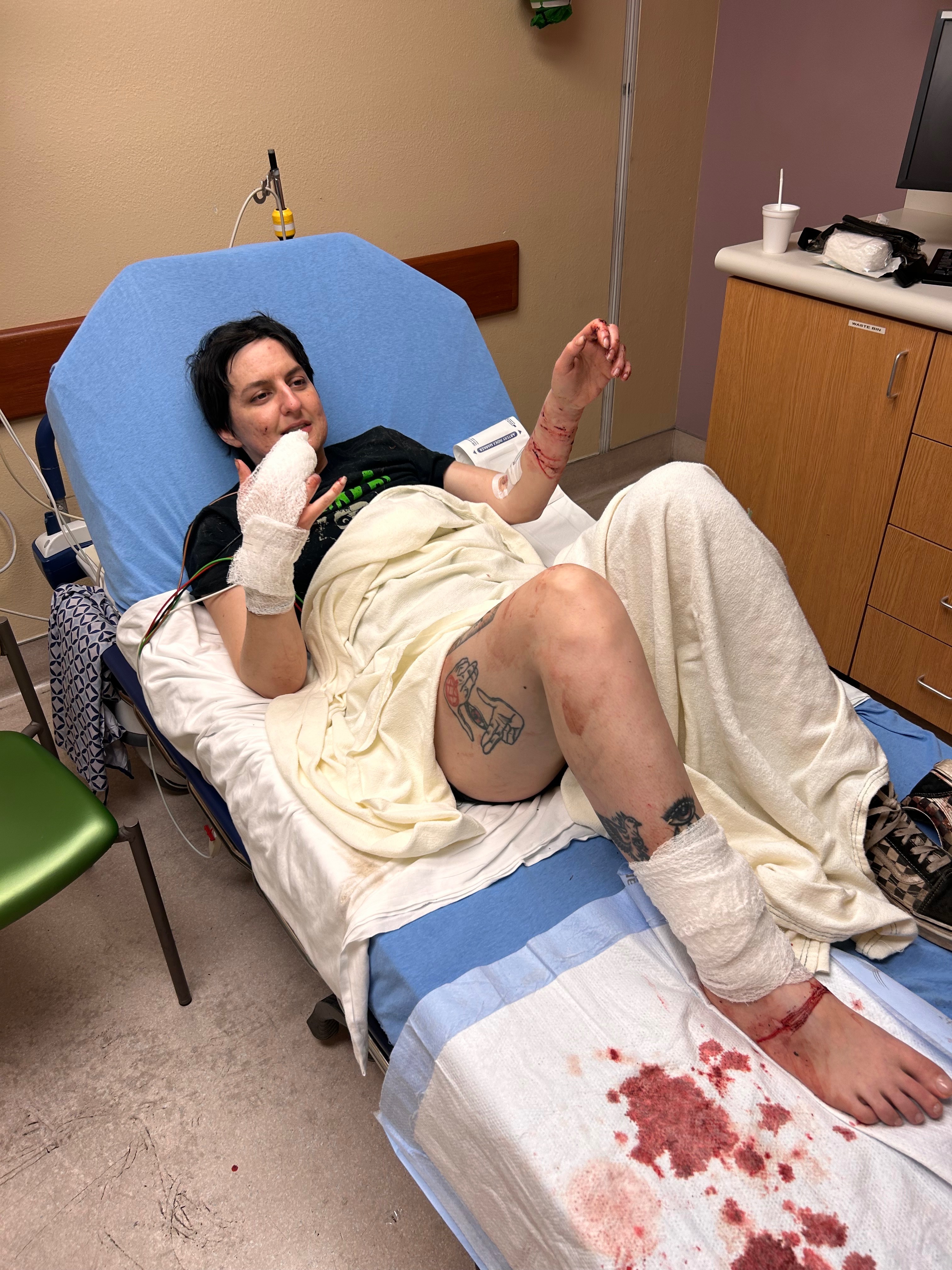 Support Jas's Recovery After Dog Attack campaign photo, 4 of 5