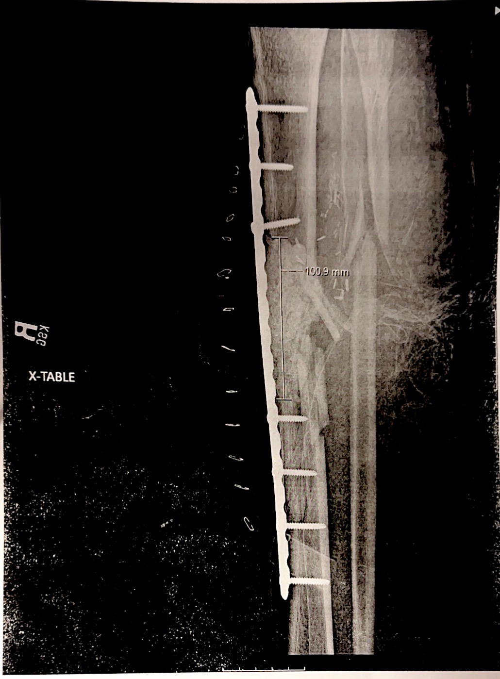 Support Recovery After Bike Accident campaign photo, 5 of 8