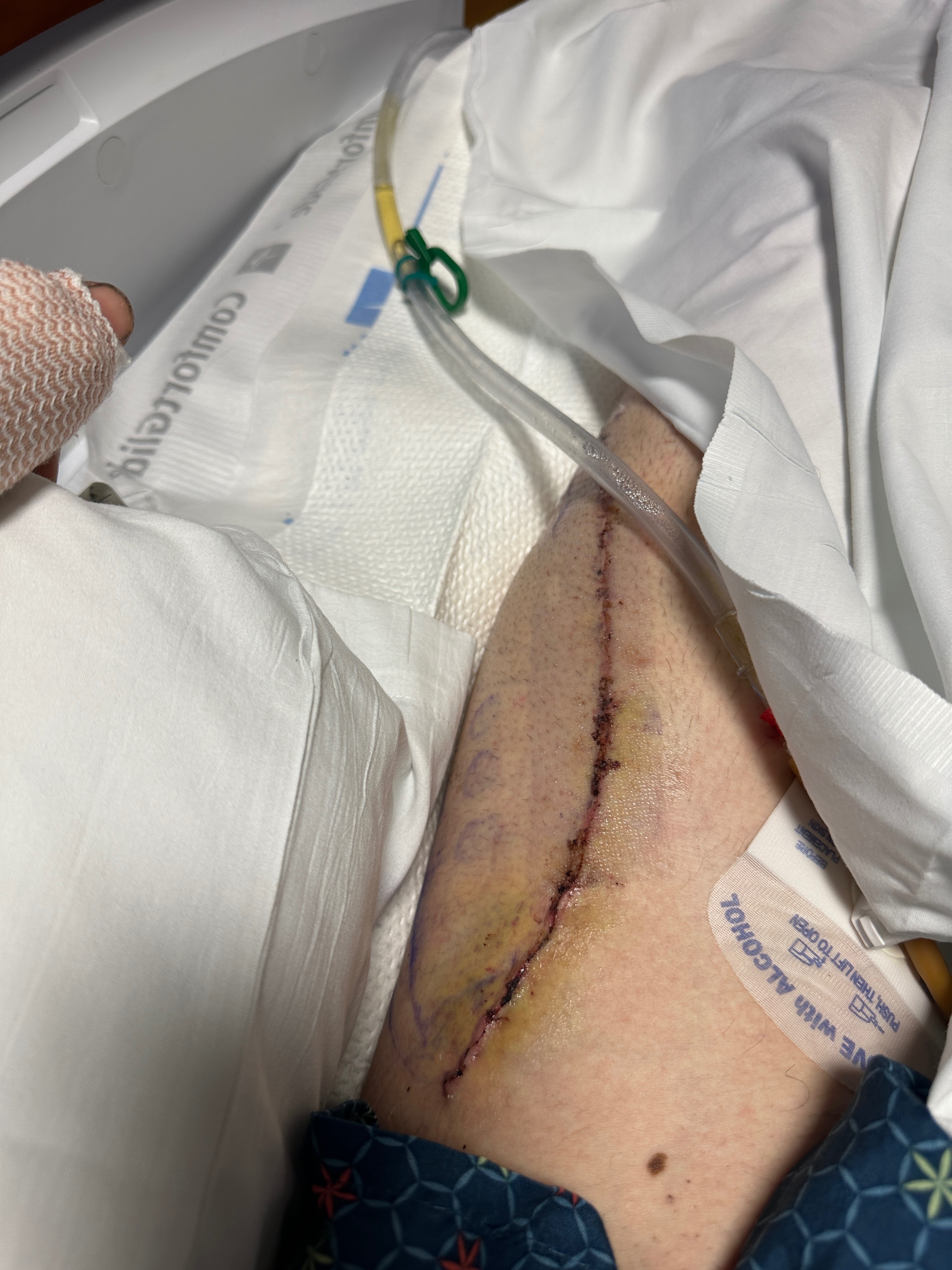 Support Recovery After Bike Accident campaign photo, 6 of 8