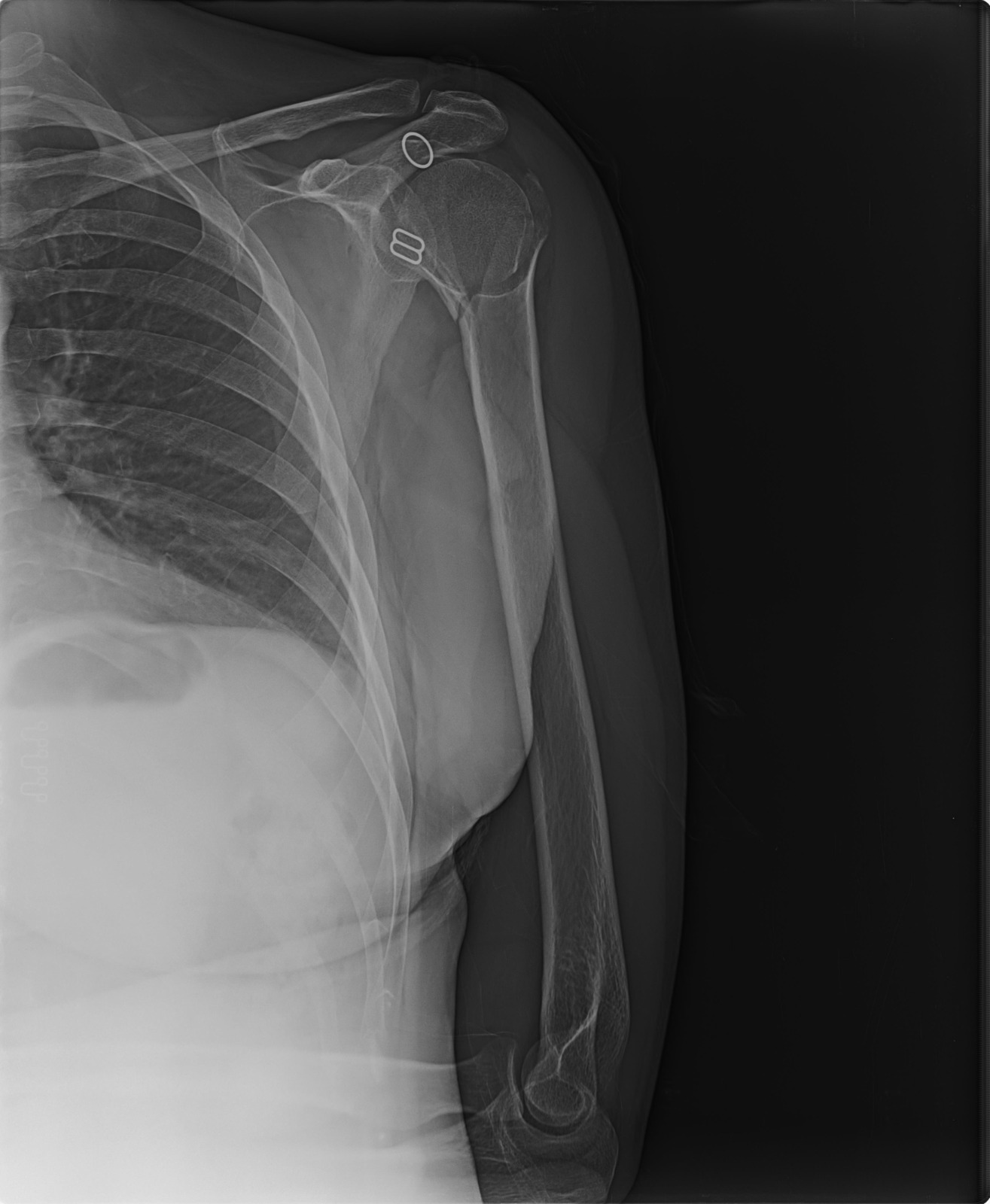 Help Ale with her surgery for her shattered arm campaign photo, 4 of 5