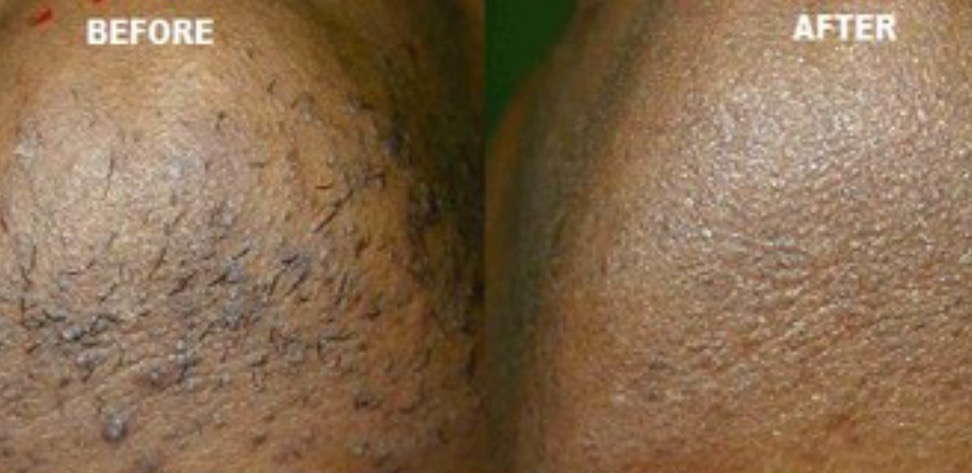 Electrolysis for All: Funding Hair Freedom in NYC! campaign photo, 4 of 8