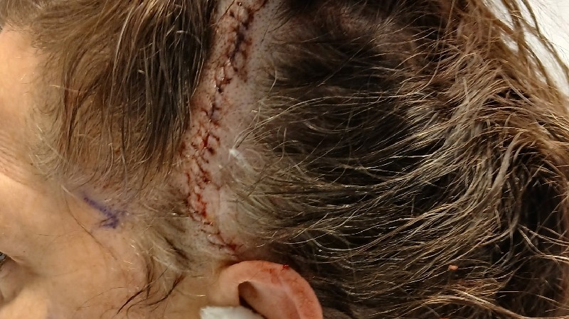 Help Emily's Mom Heal from CSF Leak