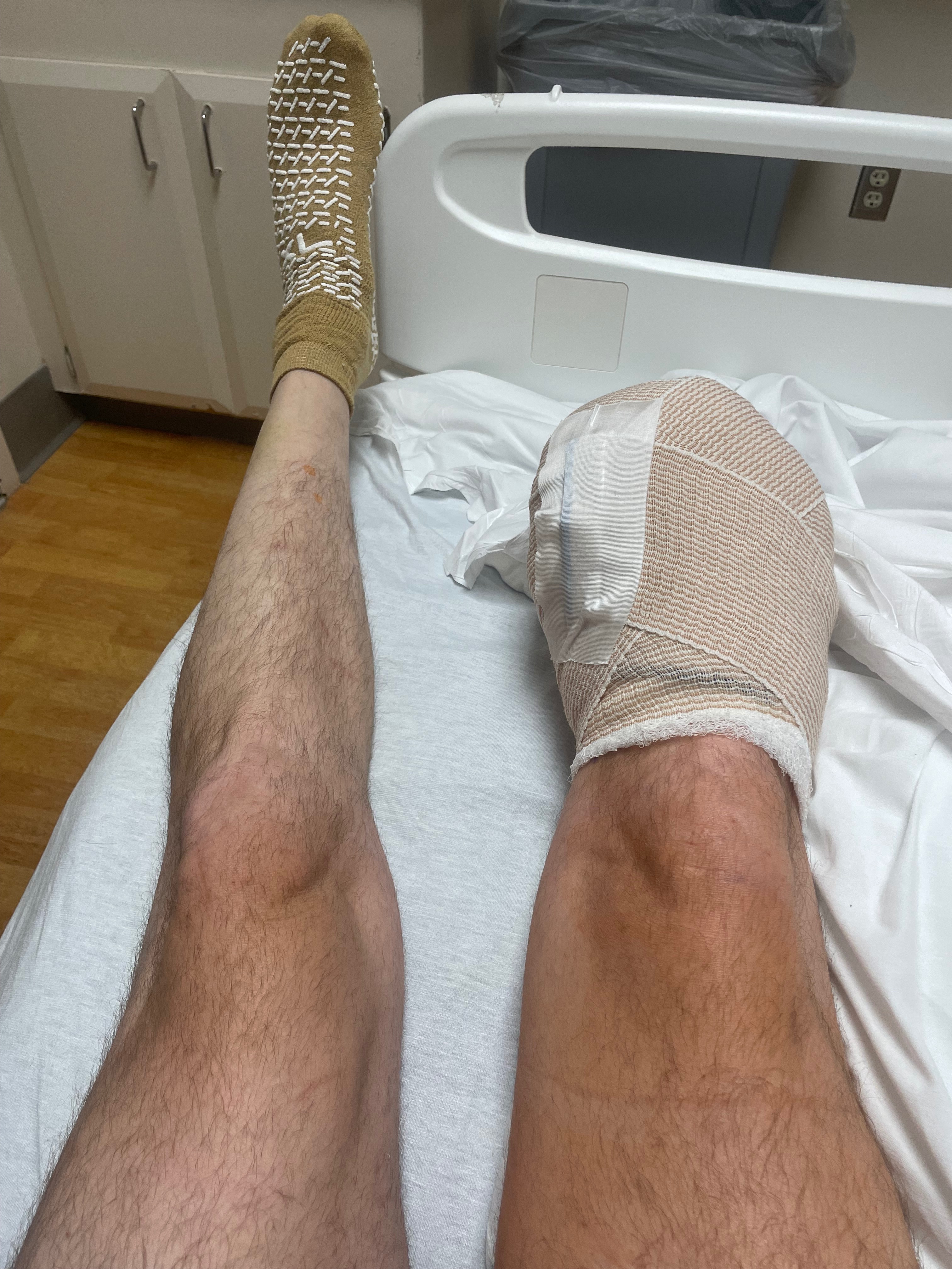 Donate to Michael Altman's Prosthetic Leg Fund campaign photo, 4 of 5