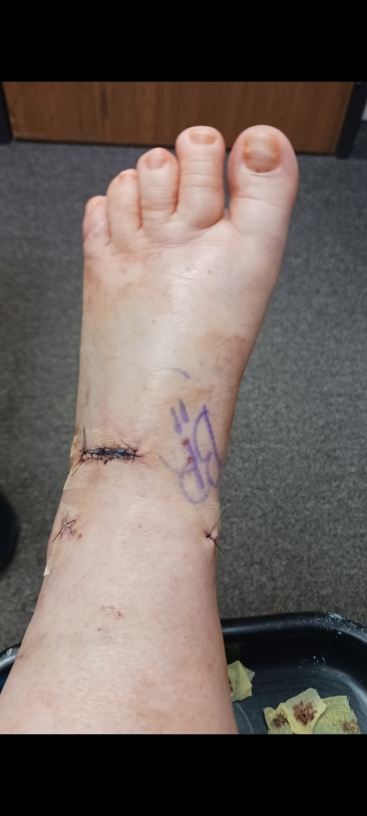 Help Overcome Ankle Surgery Setbacks campaign photo, 7 of 8