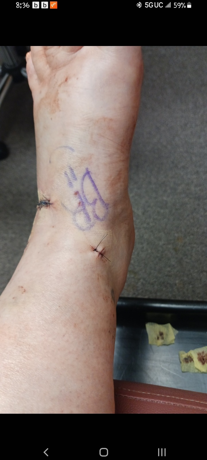 Help Overcome Ankle Surgery Setbacks campaign photo, 2 of 8