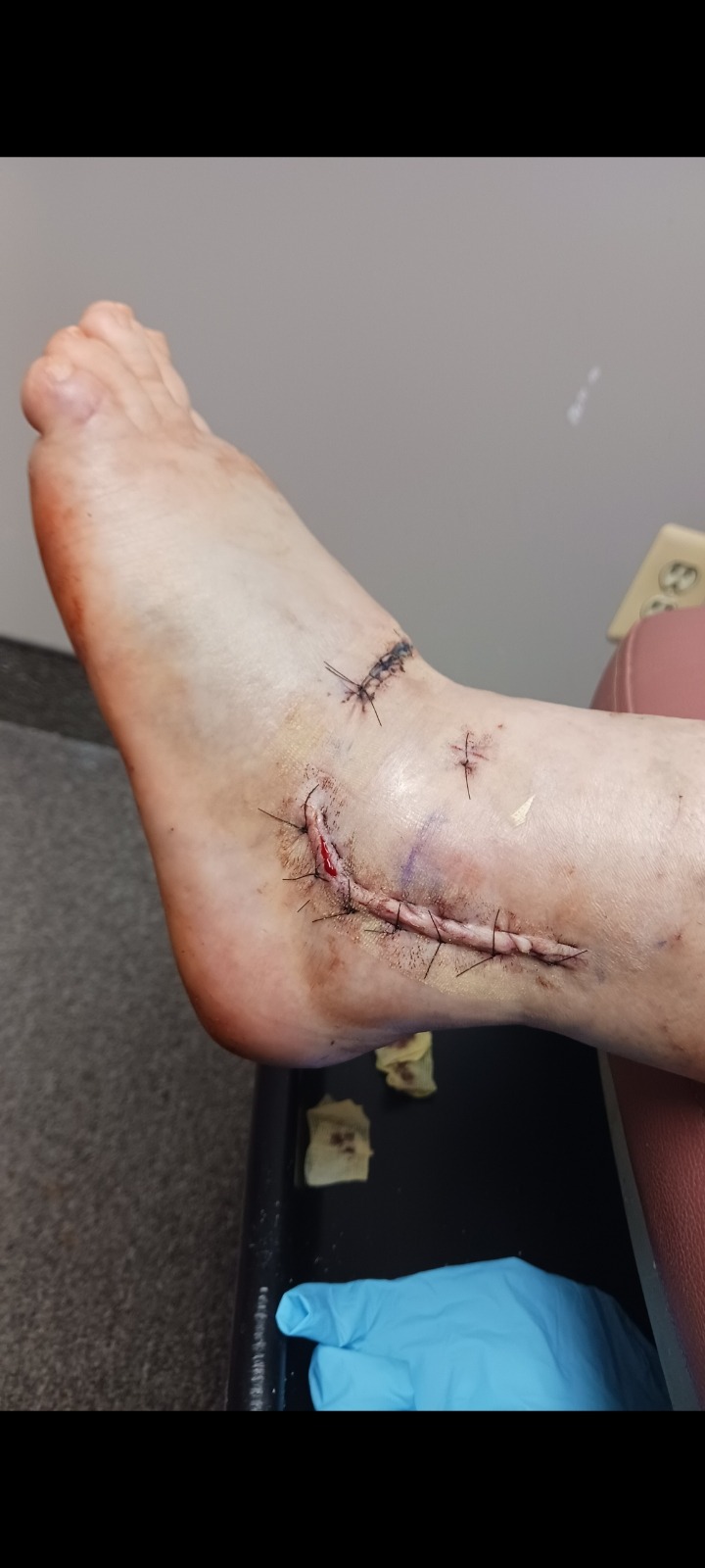 Help Overcome Ankle Surgery Setbacks campaign photo, 4 of 8