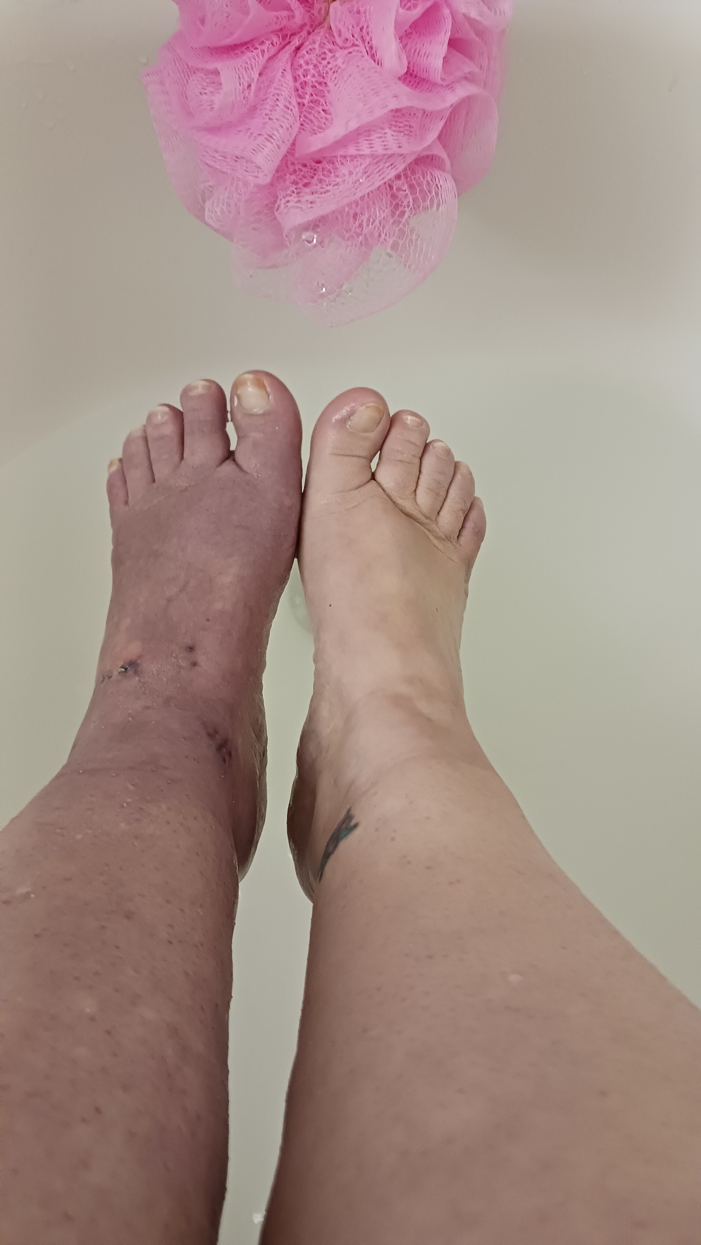 Help Overcome Ankle Surgery Setbacks campaign photo, 5 of 8