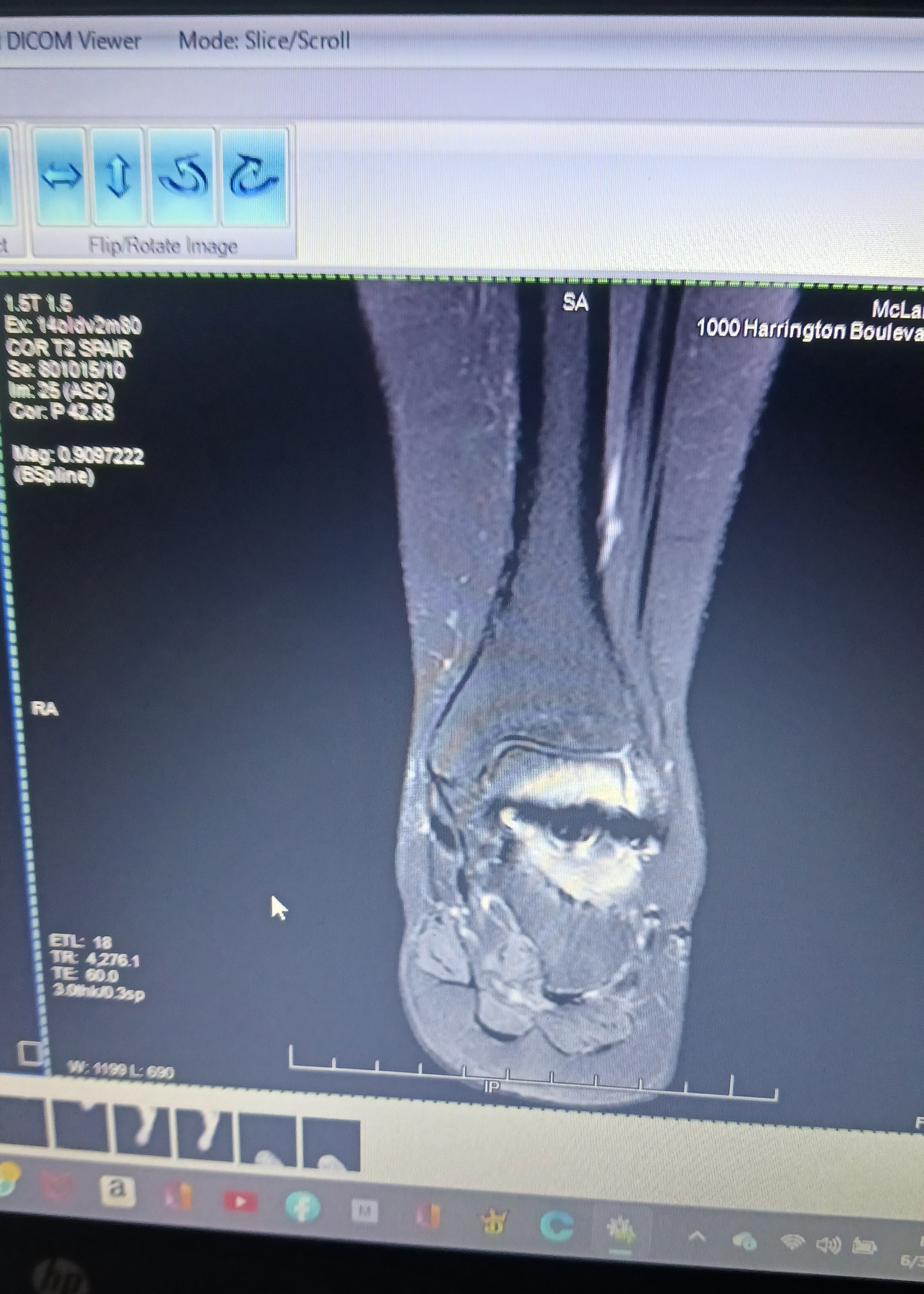 Help Overcome Ankle Surgery Setbacks campaign photo, 6 of 8