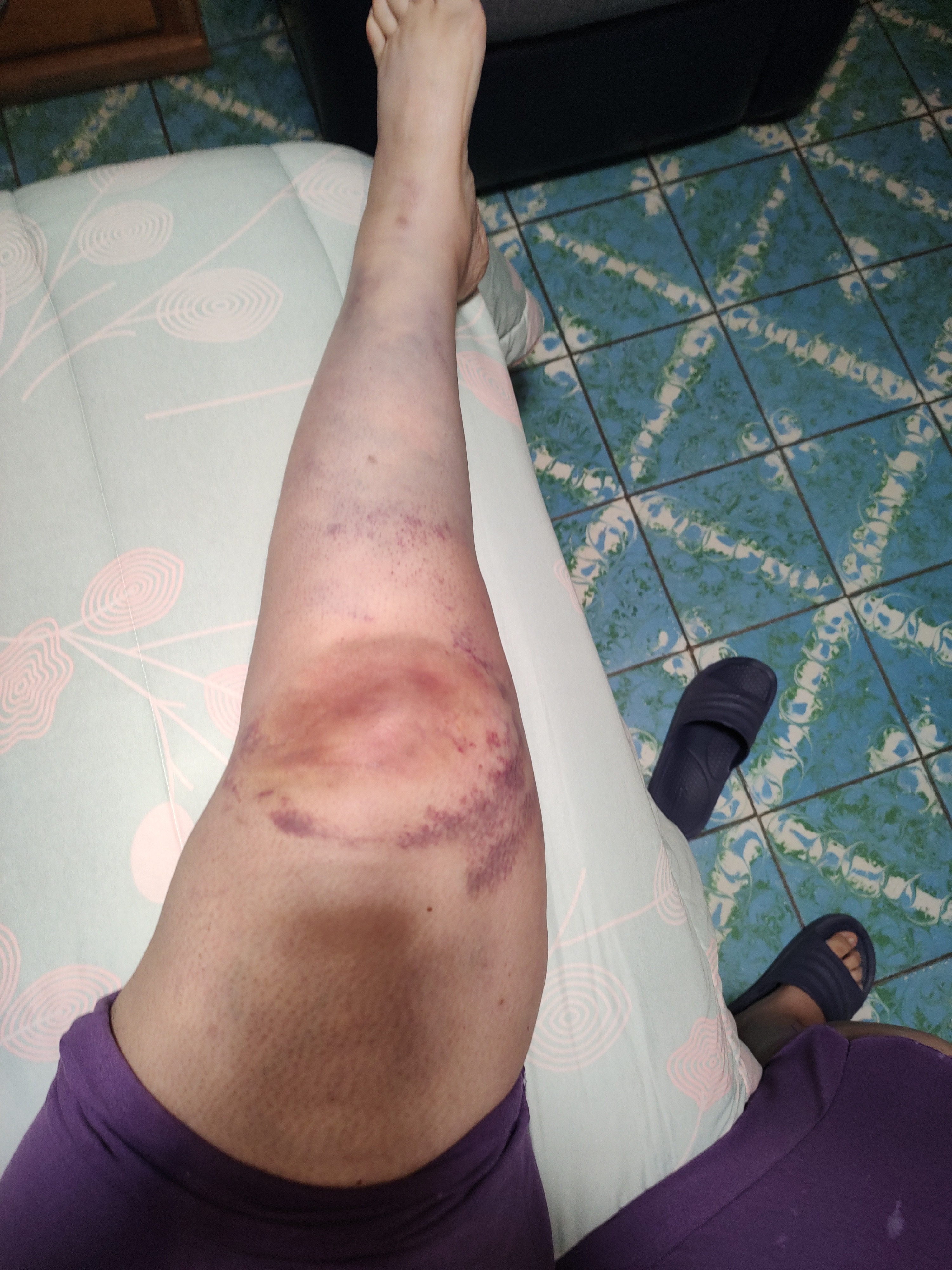 Cirugía de hombro derecho y rodilla izquierda por accidente campaign photo, 2 of 6