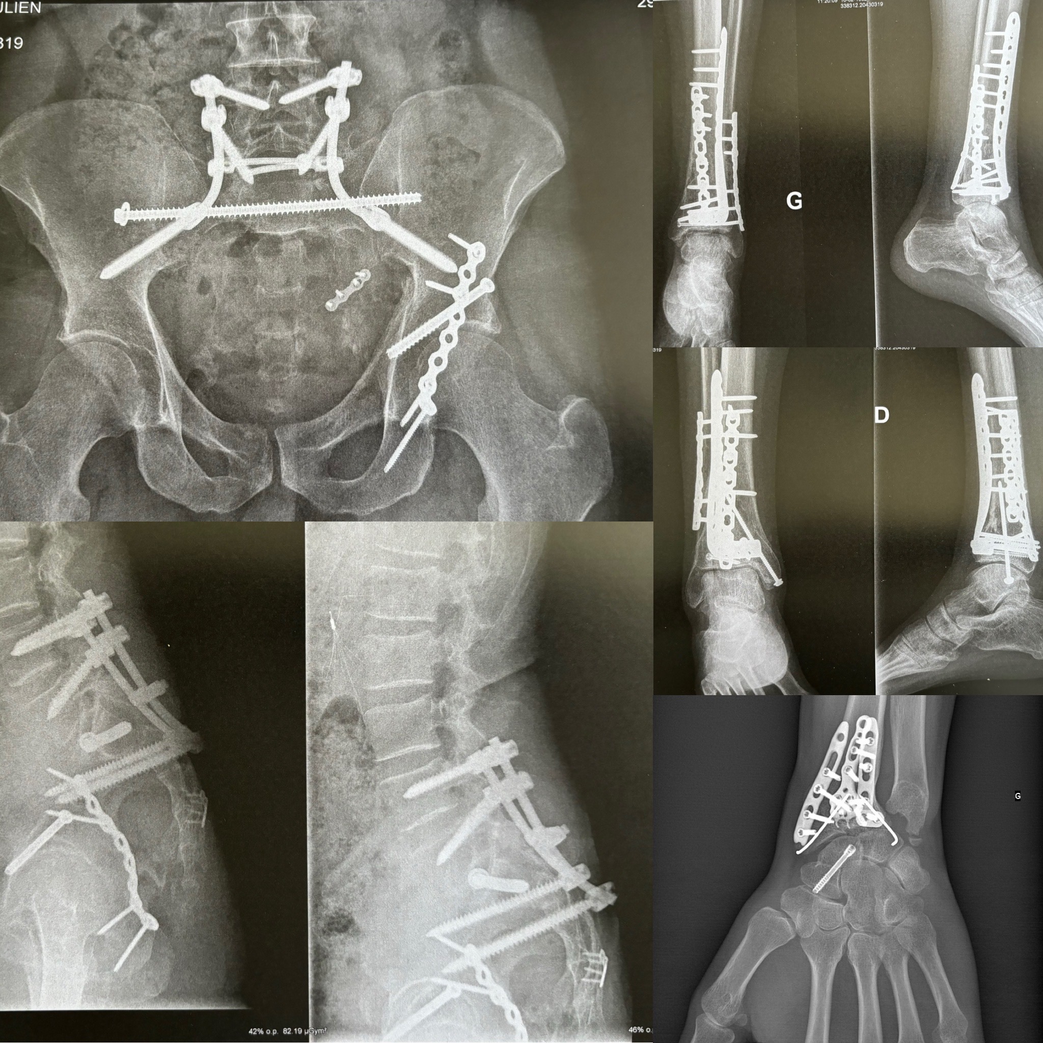 Help Julien get Surgery After a Life-Changing Accident campaign photo, 2 of 8