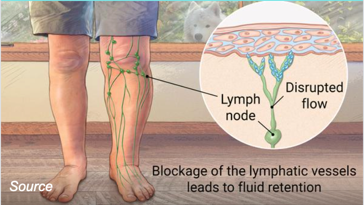 Kevin's Journey to Overcome Lymphedema campaign photo, 4 of 5