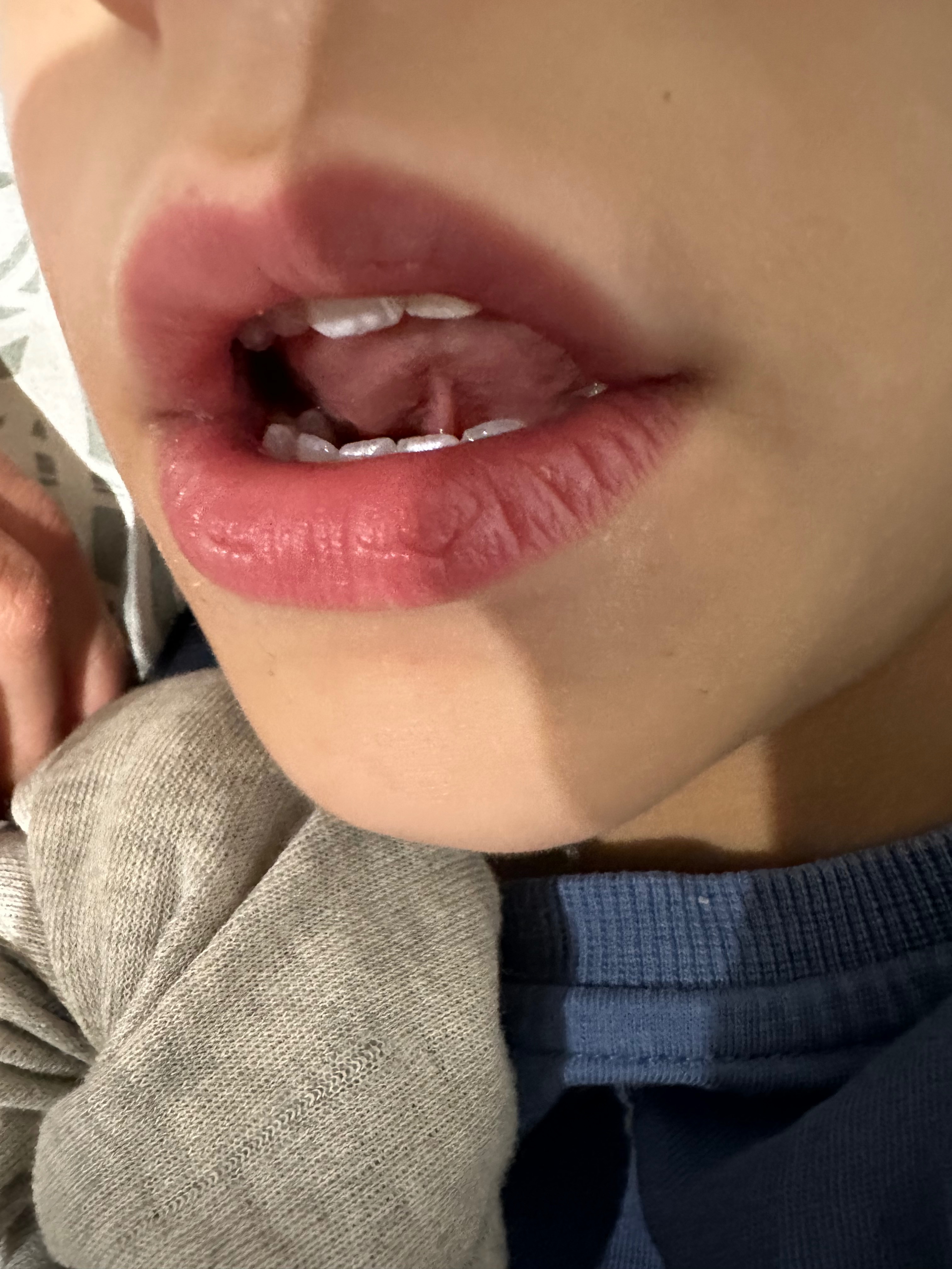 Please help  Adenoidectomy and tongue tie surgery campaign photo, 2 of 4