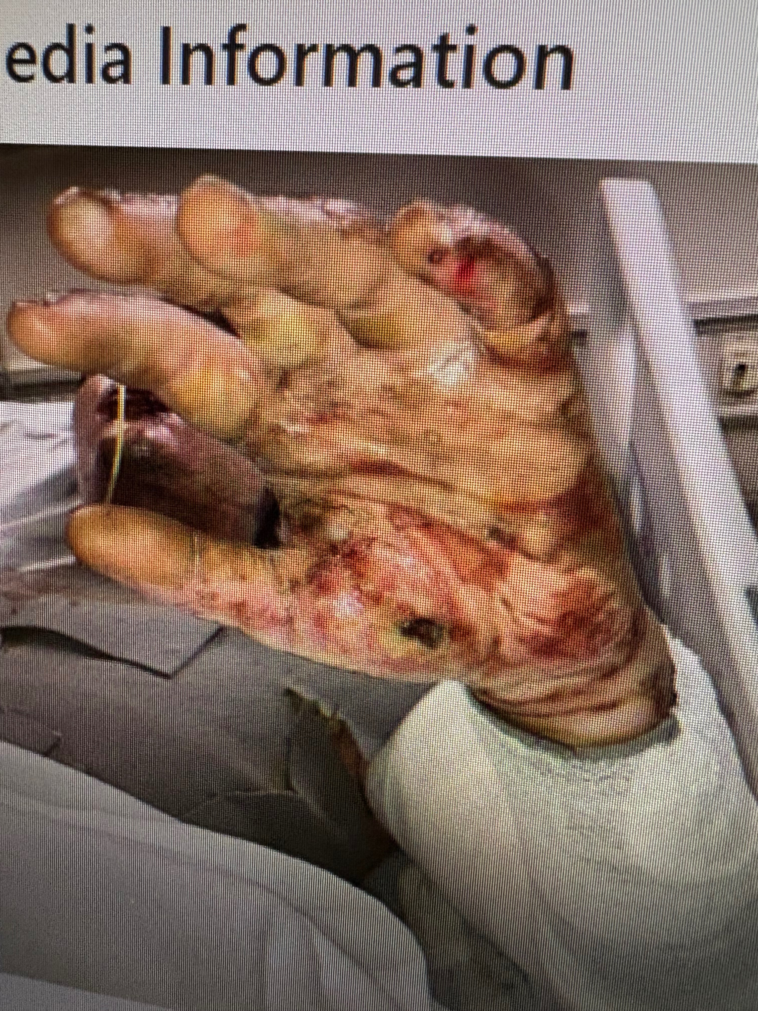 Help Jacob Ingram Critical Burn Recovery campaign photo, 5 of 7