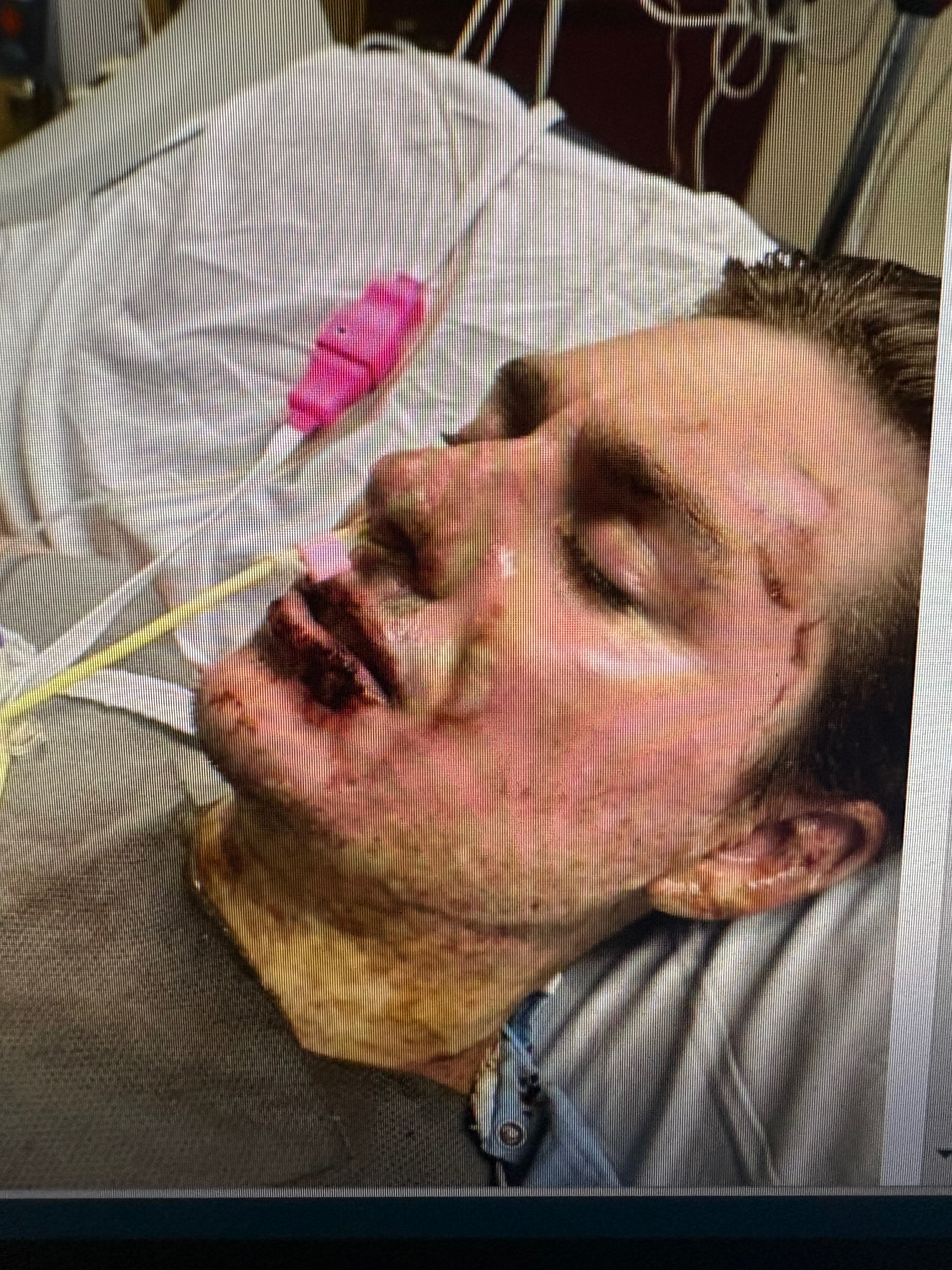 Help Jacob Ingram Critical Burn Recovery campaign photo, 4 of 7