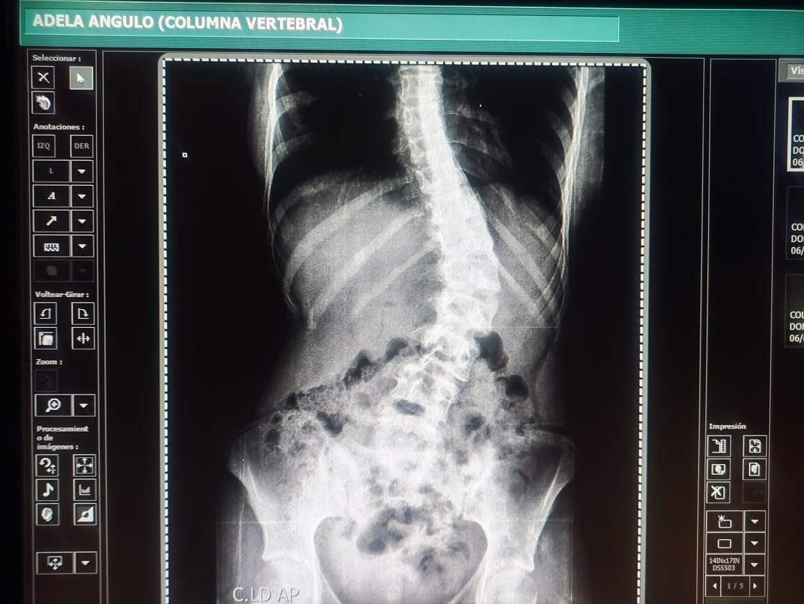 Help Adela Valentina Get Life-Changing Spine Surgery campaign photo, 4 of 8