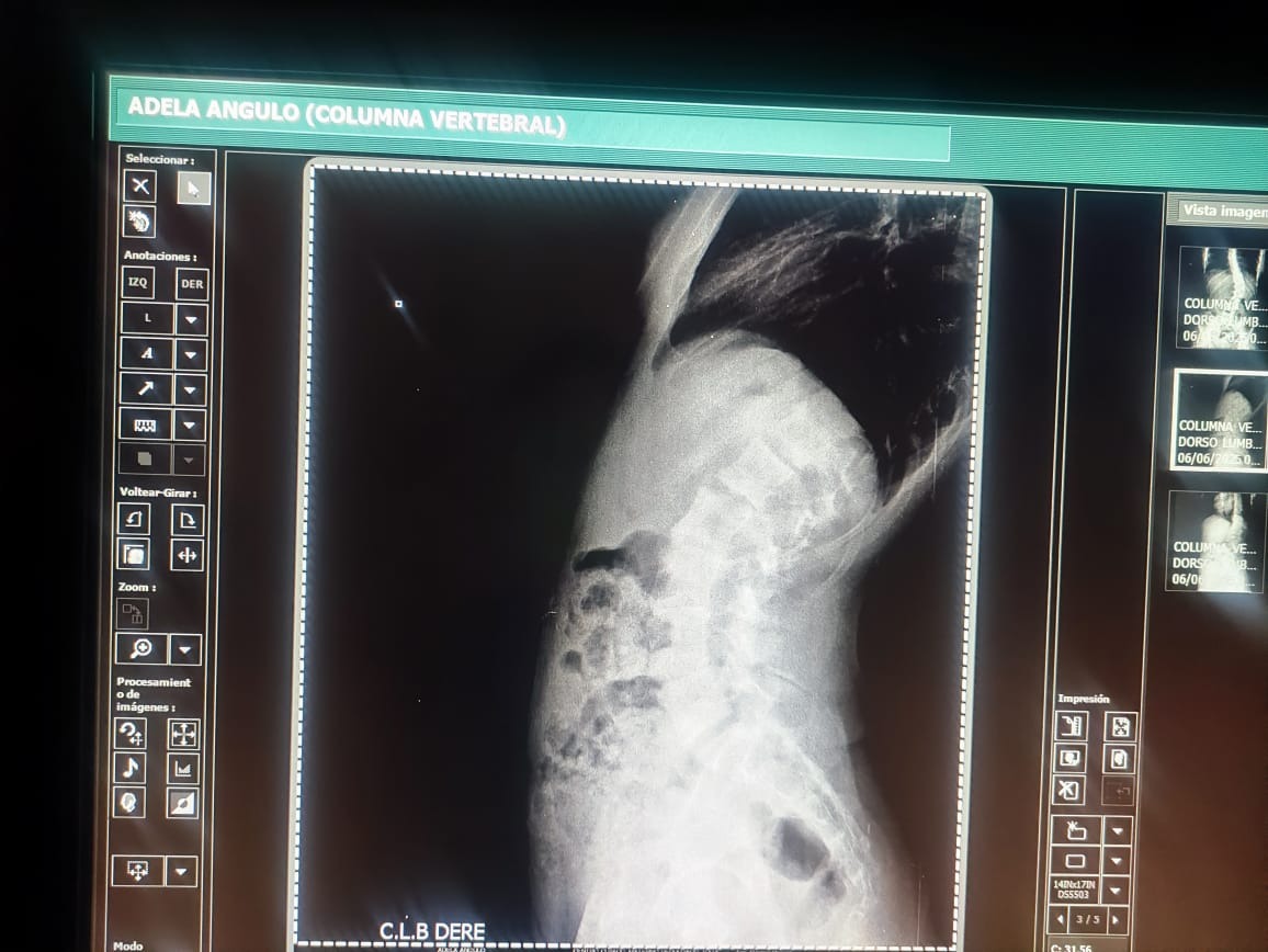 Help Adela Valentina Get Life-Changing Spine Surgery campaign photo, 5 of 8