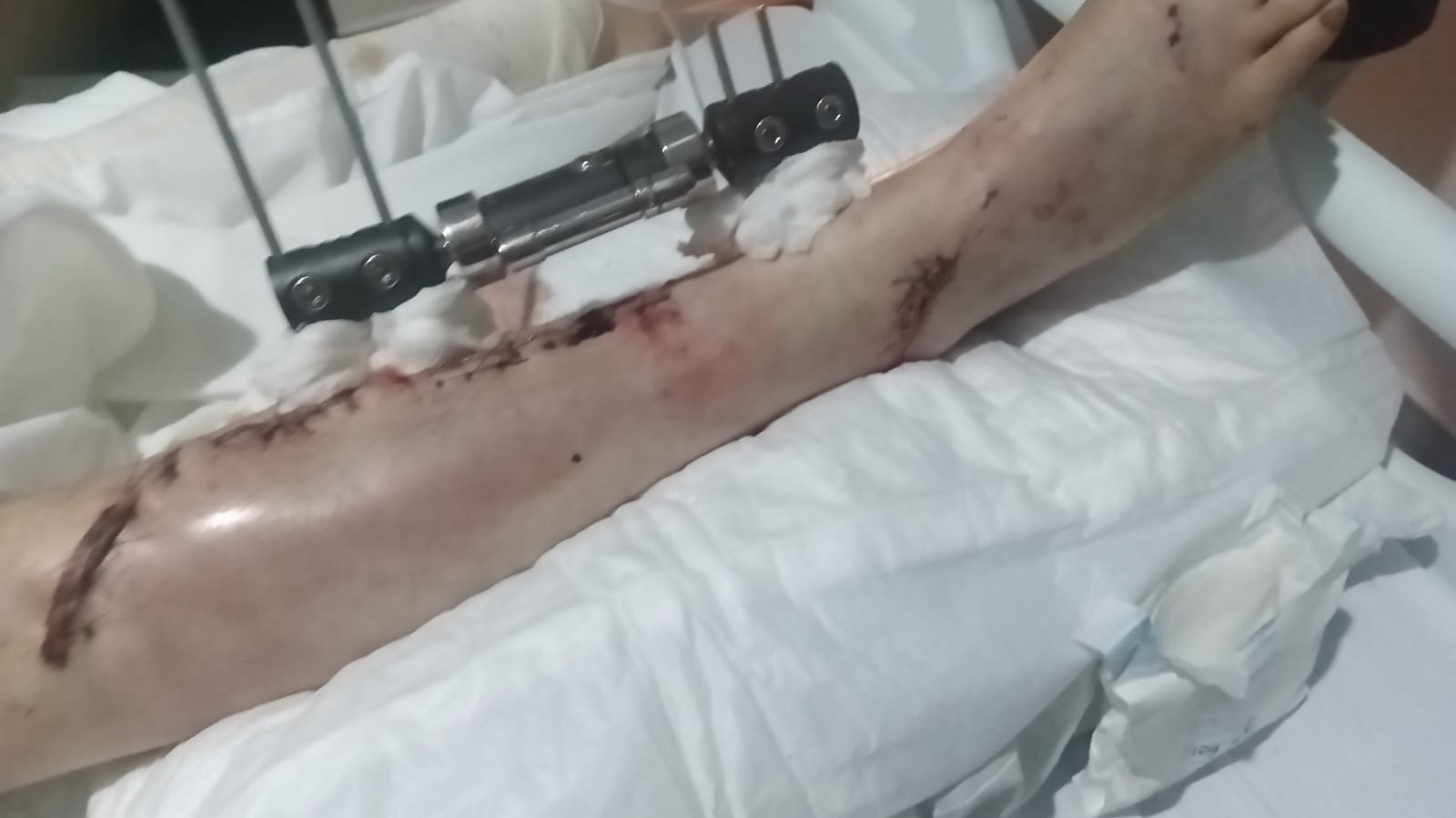 Medical bills and living expenses for Johan Bartsch. campaign photo, 2 of 6