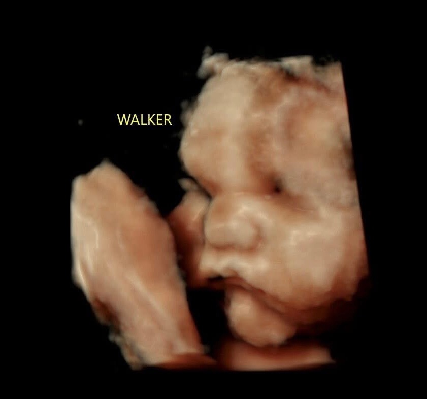 Walker’s Journey: A Heart to Heal, A Family to Hold campaign photo, 2 of 4