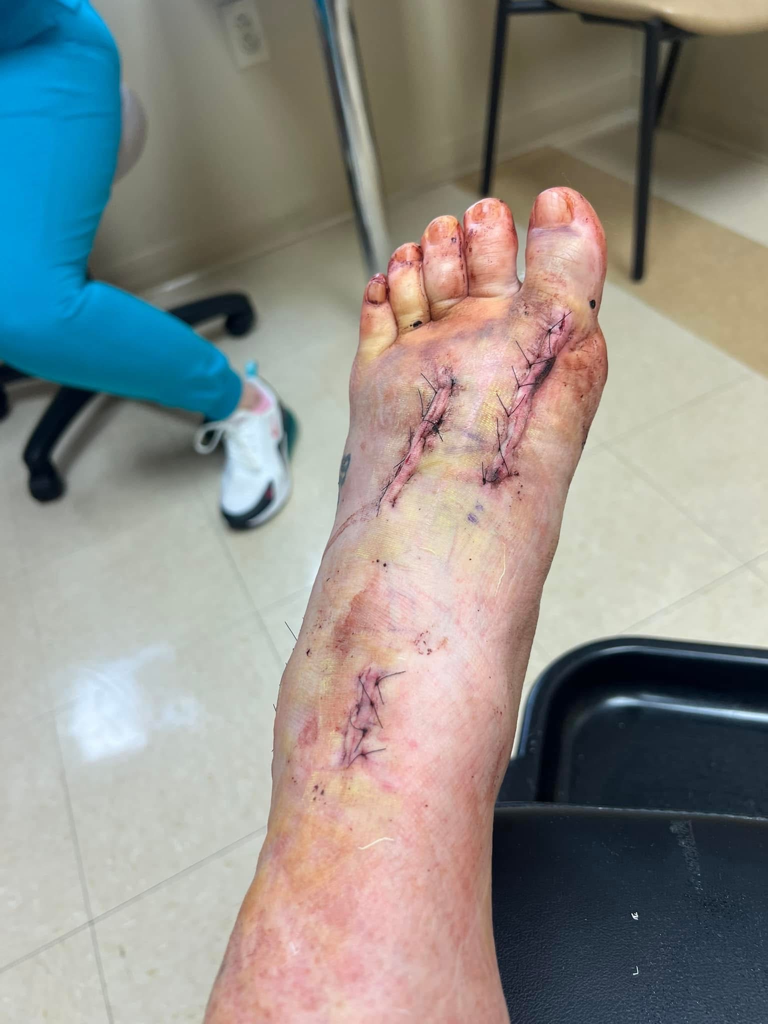 Aura’s Foot Surgery Recovery Fund campaign photo, 4 of 8