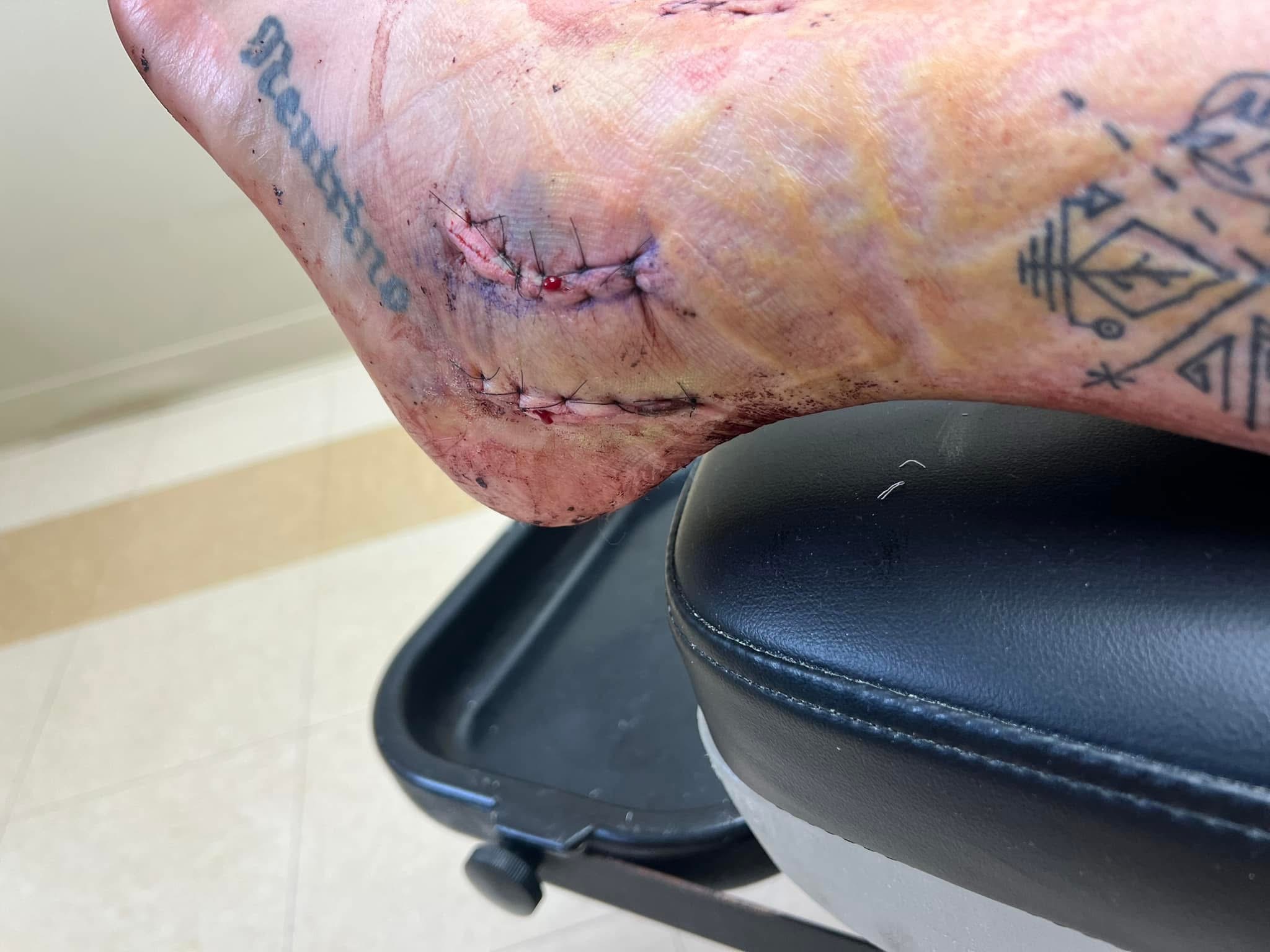 Aura’s Foot Surgery Recovery Fund campaign photo, 6 of 8