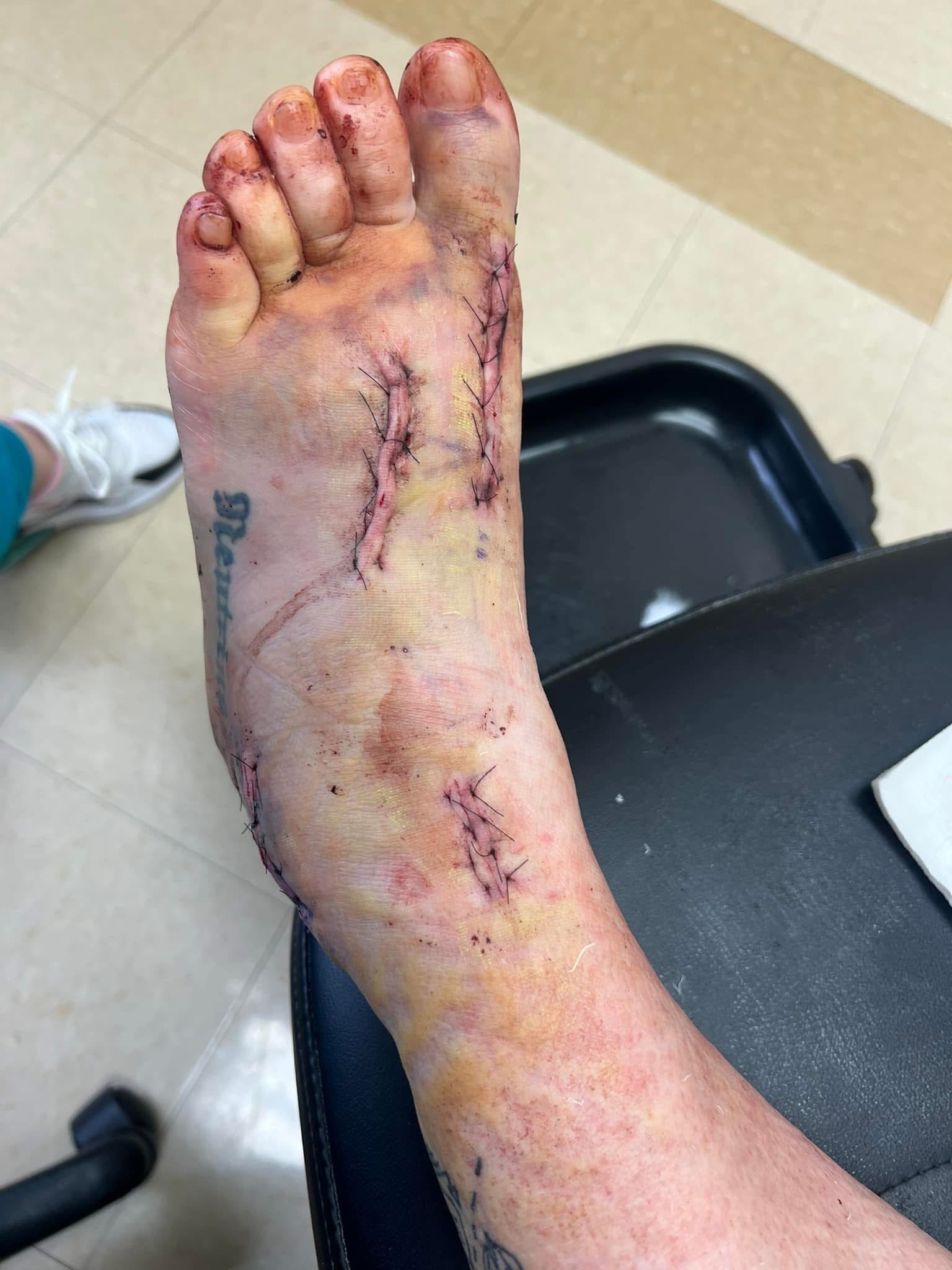 Aura’s Foot Surgery Recovery Fund campaign photo, 2 of 8