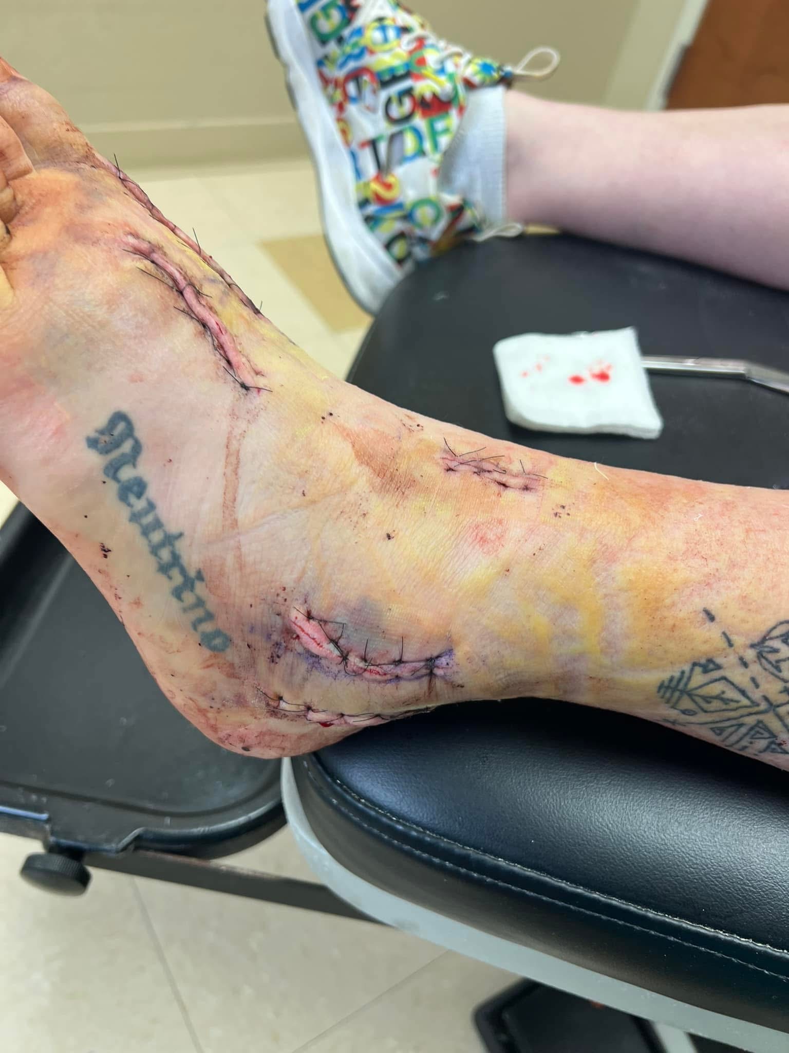 Aura’s Foot Surgery Recovery Fund campaign photo, 5 of 8