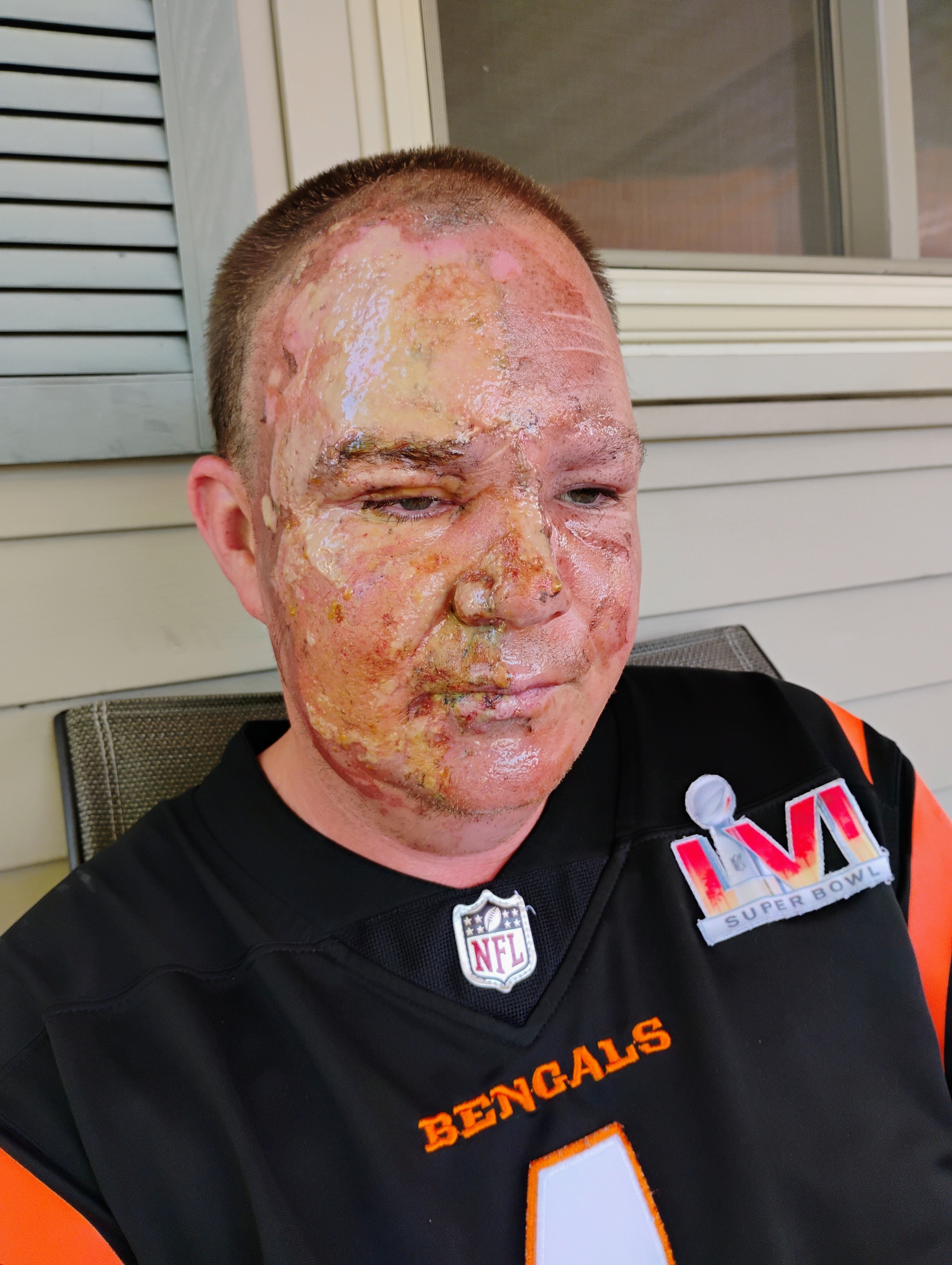 Support Jason's Recovery After Fire Accident campaign photo, 2 of 3