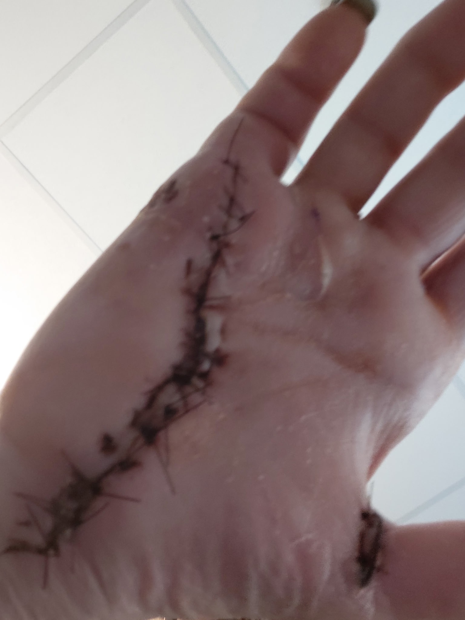 Support Donna's Recovery After Dog Bite campaign photo, 2 of 7